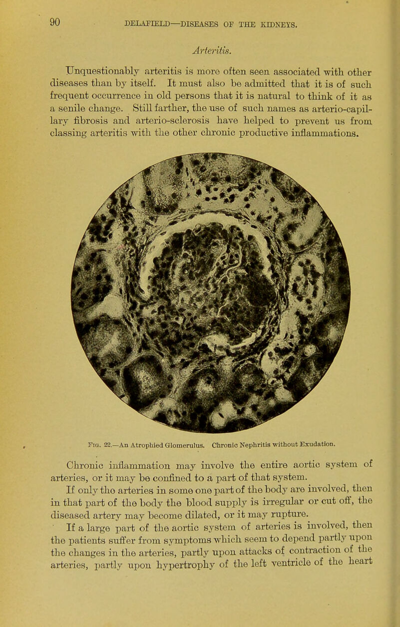 Arteritis. Unquestionably arteritis is more often seen associated with other diseases than by itself. It must also be admitted that it is of such frequent occurrence in old persons that it is natural to tbiTiV of it as a senile change. Still farther, the use of such names as arterio-capil- lary fibrosis and arterio-sclerosis have helped to prevent us from classing arteritis with the other chronic productive infiammations. Fig. 22.—An Atrophied Glomerulus. Chronic Nephritis without Exudation. Chronic inflammation may involve the entire aortic system of arteries, or it may be confined to a part of that system. If only the arteries in some one pail; of the body are involved, then in that part of the body the blood supply is irregular or cut off, the diseased artery may become dilated, or it may rupture. If a large part of the aortic system of arteries is involved, then the patients suffer from symptoms which seem to dej)eud jiartly upon the changes in the arteries, partly upon attacks of contraction of the arteries, i)artly upon hypertrophy of the left ventricle of the heart