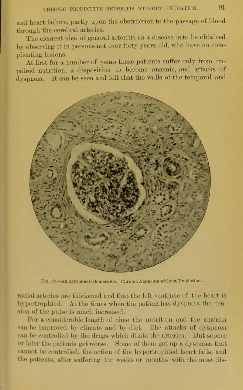 auci heai-t failure, partly upon the obstruction to the passage of blood through the cerebral ai*teries. The clearest idea of general arteritis as a disease is to be obtained by observing it in persons not over forty years old, who have no com- plicating lesions. At first for a number of years these patients suffer only from im- paired nutrition, a disposition to become amemic, and attacks of dyspnoea. It can be seen and felt that the walls of the temporal and Fio. 23.—An Atrophied Glomerulus. Chronic Nephritis without Exudation. radial arteries are thickened and that the left ventricle of the heart is hypertroijhied. At the times when the patient has dyspnoea the ten- sion of the pulse is much increased. For a considerable length of time the nutrition and the anremia can be irn[)roved by climate and by diet. The attacks of dyspnoea can be controlled by the drugs whicli dilate tlie arteries. But sooner or later the ]»atients get worse. Some of tliem get up a dyspnoea that cannot be contrr>lled, tlie action of tlie hypertrojiliied heart fails, and the j>atients, aftfu' suffering for weeks or montlis with the most dis-