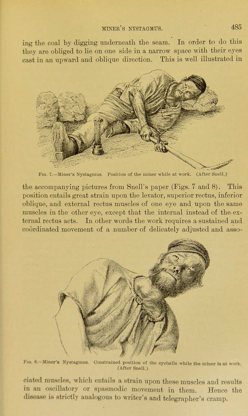 iug tlie coal by digging underneath the seam. In order to do this they are obliged to lie on one side in a narrow space with their eyes cast in an upward and oblique direction. This is well illustrated in Fig. 7.—Miner's Nystagmus. Position of the miner while at work. (After Snell.) the accompanying pictures from Snell's paper (Figs. 7 and 8). This position entails great strain upon the levator, superior rectus, inferior oblique, and external rectus muscles of one eye and upon the same muscles in the other eye, except that the internal instead of the ex- ternal rectus acts. In other words the work requires a sustained and coordinated movement of a number of delicately adjusted and asso- Fio. a—Miner's Nystajcmus. Constrained position of the eyeballs while the miner is at work. (After Snell.) ciated muscles, which entails a strain upon these muscles and results in an oscillatory or si)aHmodic movement in them. Hence the disease is strictly analogous to writer's and telegrapher's cramp.