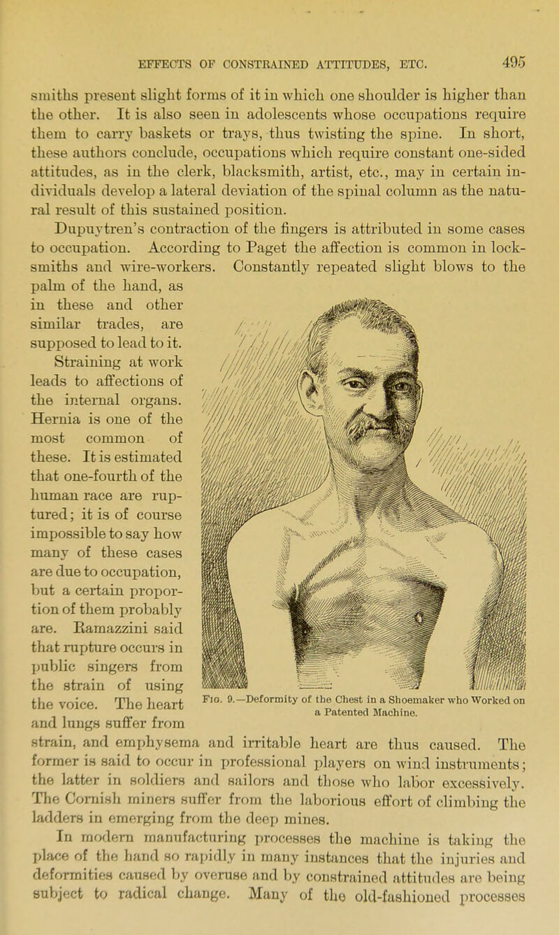 smiths present slight forms of it iu which one shoulder is higher than the other. It is also seen in adolescents whose occupations require them to carry baskets or trays, thus twisting the spine. In short, these authors conclude, occupations which require constant one-sided attitiides, as in the clerk, blacksmith, artist, etc., may in certain in- dividuals develop a lateral deviation of the spinal column as the natu- ral result of this sustained i^osition. Dupuytren's contraction of the fingers is attributed iu some cases to occupation. According to Paget the aifection is common in lock- smiths and wire-workers. Constantly repeated slight blows to the palm of the hand, as in these and other similar trades, are supposed to lead to it. Straining at work leads to affections of the internal organs. Hernia is one of the most common of these. It is estimated that one-fourth of the human race are rup- tured ; it is of course impossible to say how many of these cases are due to occupation, but a certain propor- tion of them probably are. Eamazzini said that rupture occurs in public singers from the strain of using the voice. The heart and lungs suffer from strain, and emphysema and irritable heart are thus caused. The former is said to occur in professional players on wind instruments; the latter in soldiers and sailors and those who labor excessively. The Cornish miners suffer from the laborious effort of climbing the ladders in emerging from the deep mines. In modem manufacturing processes the machine is taking the place of the hand so rapidly in many instances that the injuries and deformities caused by overuse and by constrained attitudes are being subject to radical change. Many of the old-fashioned processes Fio. 0.—Deformity of the Chest in a Shoemalcer who Worked on a Patented Machine.