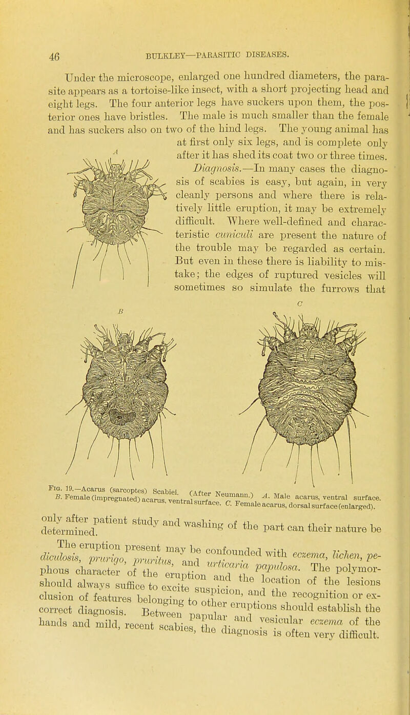 Under tlie microscope, enlarged one hundred diameters, the para- site appears as a tortoise-like insect, with a short projecting head and eight legs. The four anterior legs have suckers upon them, the pos- terior ones have bristles. The male is much smaller than the female and has suckers also on two of the hind legs. The young animal has at first only six legs, and is complete only after it has shed its coat two or three times. Diagnosis.—In many cases the diagno- sis of scabies is easy, but again, in very cleanly persons and where there is rela- tively little eruption, it may be extremely difficult. Where well-defined and charac- teristic cuniculi are present the nature of the trouble may be regarded as certain. But even in these there is liability to mis- take; the edges of ruptured vesicles will sometimes so simulate the furrows that c determinedPatieUt ^ Wasllin& of tbe Part can their nature be ^f°uuded with lichen, pe- Phous character of T T' ?6 »°*mor- should always suffice to excite suspicion ^ wi °f ^.6 leS1°US elusion of features belonging to other o, ^ re™gmtl0U or ex correct diagnosis. Between mpul x • 1?, ** “ 6stablis]l the Hands and mild, recent scabies' L/di, T6^0111 eczema of tlie 6S, tlie diagnosis is often very difficult.