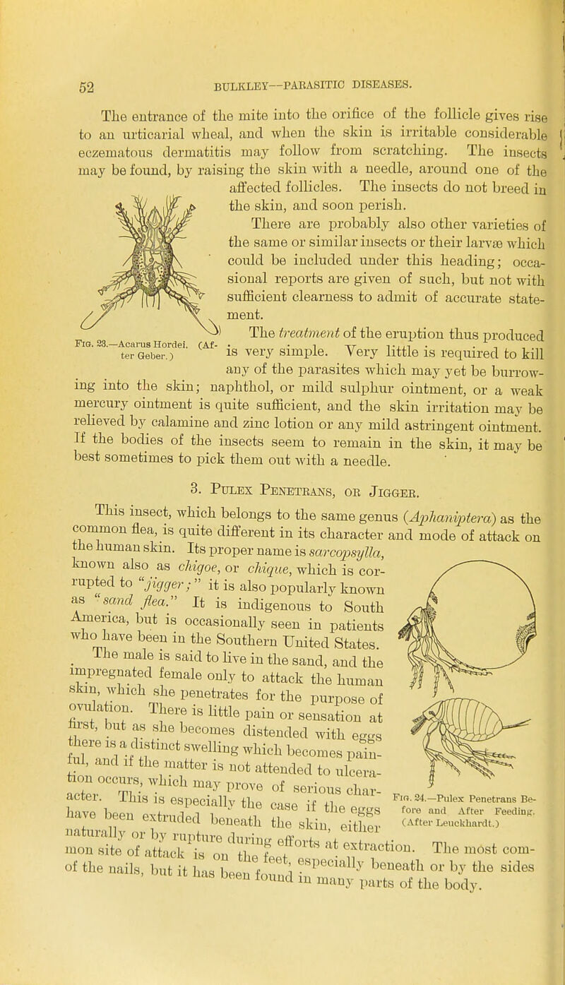 Tlie entrance of tire mite into tlie orifice of tlie follicle gives rise to an urticarial wheal, and when the skin is irritable considerable eczematous dermatitis may follow from scratching. The insects may be found, by raising the skin with a needle, around one of the affected follicles. The insects do not breed in the skin, and soon perish. There are probably also other varieties of the same or similar insects or their larvae which could be included under this heading; occa- sional reports are given of such, but not with sufficient clearness to admit of accurate state- ment. The treatment of the eruption thus produced terGeber.) is very simple. Very little is required to kill any of the parasites which may yet be burrow- ing into the skin; naphthol, or mild sulphur ointment, or a weak mercury ointment is quite sufficient, and the skin irritation may be relieved by calamine and zinc lotion or any mild astringent ointment. If the bodies of the insects seem to remain in the skin, it may be best sometimes to pick them out with a needle. 3. Pules Penetrans, or Jigger. This insect, which belongs to the same genus (.Aphaniptera) as the common flea, is quite different in its character and mode of attack on the human skin. Its proper name is sarcopsylla, known also as chigoe, or chique, which is cor- rupted to “jigger; ” it is also popularly known as “sand flea.” It is indigenous to South America, but is occasionally seen in patients who have been in the Southern United States. . 1 he male 18 said to live in the sand, and the impregnated female only to attack the human skin which she penetrates for the purpose of fW YT' iei? 18 paiu or sensation at hist, but as she becomes distended with eggs U1Hug wMdl beoomeB P“i- iul, and if the matter is not attended to ulcera- Wn^whmhmayp^ of serious chat , ' This is especially the case if tlie eggs l ave been extruded beneath the skin, either - mcS oTirtr'Zf f * *» «*»*«■ m6st eom- of the uaii8' b‘ “ Ca ”ypabr:i sides Fig. 24.—Pulex Penetrans Be- fore and After Feeding. (After Leuckhardt.)