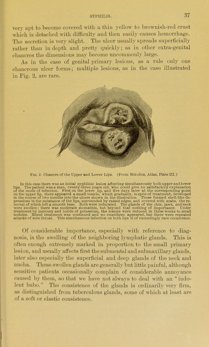 very apt to become covered with a thiu yellow to brownish-red cnist which is detached with difficulty and then easily causes hemoi-rhage. The secretion is very slight. The ulcer usually spreads supei-ficially rather than in depth and pretty quickly; as in other extra-genital chancres the dimensions may become uncommonly large. As in the case of genital i^rimary lesions, as a rule only one chancrous idcer forms; multixjle lesions, as in the case illustrated in Fig. 2, are rare. Fig. -i. Chancre of the Upper and Lower Lips. (From Mikulicz, Atlas, Plate III.) In this case there was an initial syphilitic lesion affecting simultaneously both upper and lower lips. The patient was a man, twenty-three years old, who could give no satisfactory explanation of the mode of infection. First on the lower lip, and five days later at the corresponding point on the upper lip, there appeared a small vesicle, which gradually, in spite of treatment, developed in the course of two months into the ulcers shown in the illustration. These formed shell-like de- pressions in the substance of the lips, surrounded by raised edges, and covered with scabs, the re- moval of which left a smooth base. Both were indurated. The glands of the chin, jaw-s, and neck were swollen ; there was moderate stomatitis, but beyond that nothing of importance. Under treatment by mercury and iodide of potassium, the lesions were reduced in three weeks to small nodules. Mixed treatment was contmued and no exanthem appeared, but there were repeated attack.^ of sore throat. This simultaneous infection on both lips is of exceedingly rare occurrence. Of con.siderable imijortance, especially with reference to diag- nosis, is the swelling of the neighboring lymphatic glands. This is often enough extremely marked in proportion to the small j)rimary lesion, and usually affects first the submental and submaxillary glands, later also especially the superficial and deep glands of the neck and nucha. These swollen glands are generally but little painful, although sensitive patients occasionally complain of considerable annoyance caused by them, so that we have not always to deal with an  indo- lent bubo. The consistence of the glands is ordinarily very firm, as distinguished from tuberculous glands, some of wliich at least are of a soft or elastic consistence.