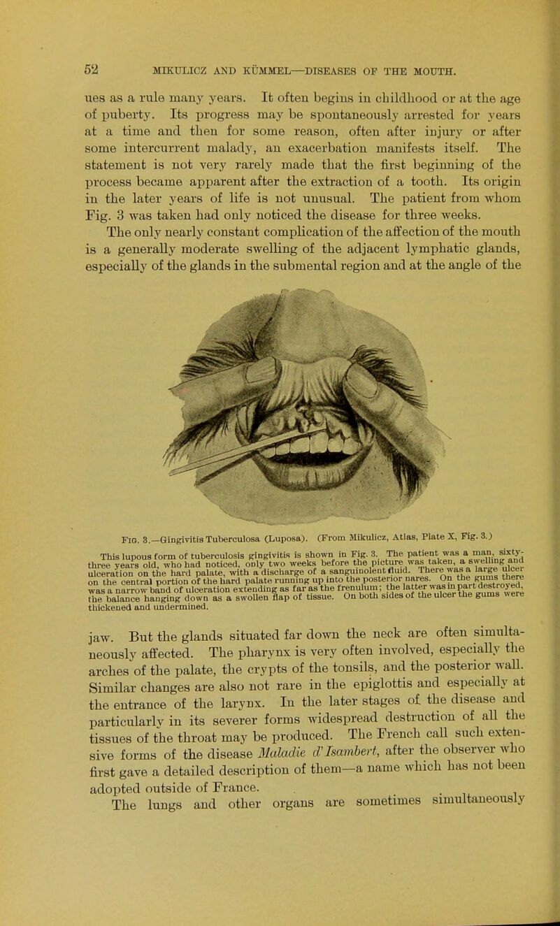 ues as a rule many years. It often begins in cbildlioocl or at the age of puberty. Its progress may be spontaneously arrested for years at a time and then for some reason, often after injury or after some intercurrent malady, an exacerbation manifests itself. The statement is not very rarely made that the first beginning of the process became apparent after the extraction of a tooth. Its origin in the later years of life is not unusual. The patient from whom Fig. 3 was taken had only noticed the disease for three weeks. The only nearly constant complication of the affection of the mouth is a generally moderate swelling of the adjacent lymphatic glands, especially of the glands in the submental region and at the angle of the Fio. 3.—Gingivitis Tuberculosa (Luposa). CFrom Mikulicz, Atlas, Plate X, Fig. S.) This lupous form of tuberculosis gingivitis is shown in Fig. 3. The P^'''^''^s a man six^^^^ three years old, who had noticed, only two weeks before tbe,P>f}}'-?,^as taken a sw^^^^^^^ ulceration on the hard palate, with a discharge of a.sangumolentflu.d. There was a large ulce. on the central portion of the bard Palate runnjng up into the posterior nares. O^ was a narrow band of ulceration extending as far as the trenulum; t^e 'atter was m part d^^^ the balance hanging down as a swoUen flap of tissue. On both sides of the ulcer the gums were thickened and undermined. jaw. But the glands situated far down the neck are often simulta- neously affected. The pharynx is very often involved, especially the arches of the palate, the crypts of the tonsils, and the posterior wall. Similar changes are also not rare in the epiglottis and especially at the entrance of the larynx. In the later stages of the disease and particularly in its severer forms widespread destruction of all the tissues of the throat may be produced. The French call such exten- sive forms of the disease Maladie d'Isambeii, after the observer who first gave a detailed description of them-a name which has not been adopted outside of France. The lungs and other organs are sometimes simultaneously