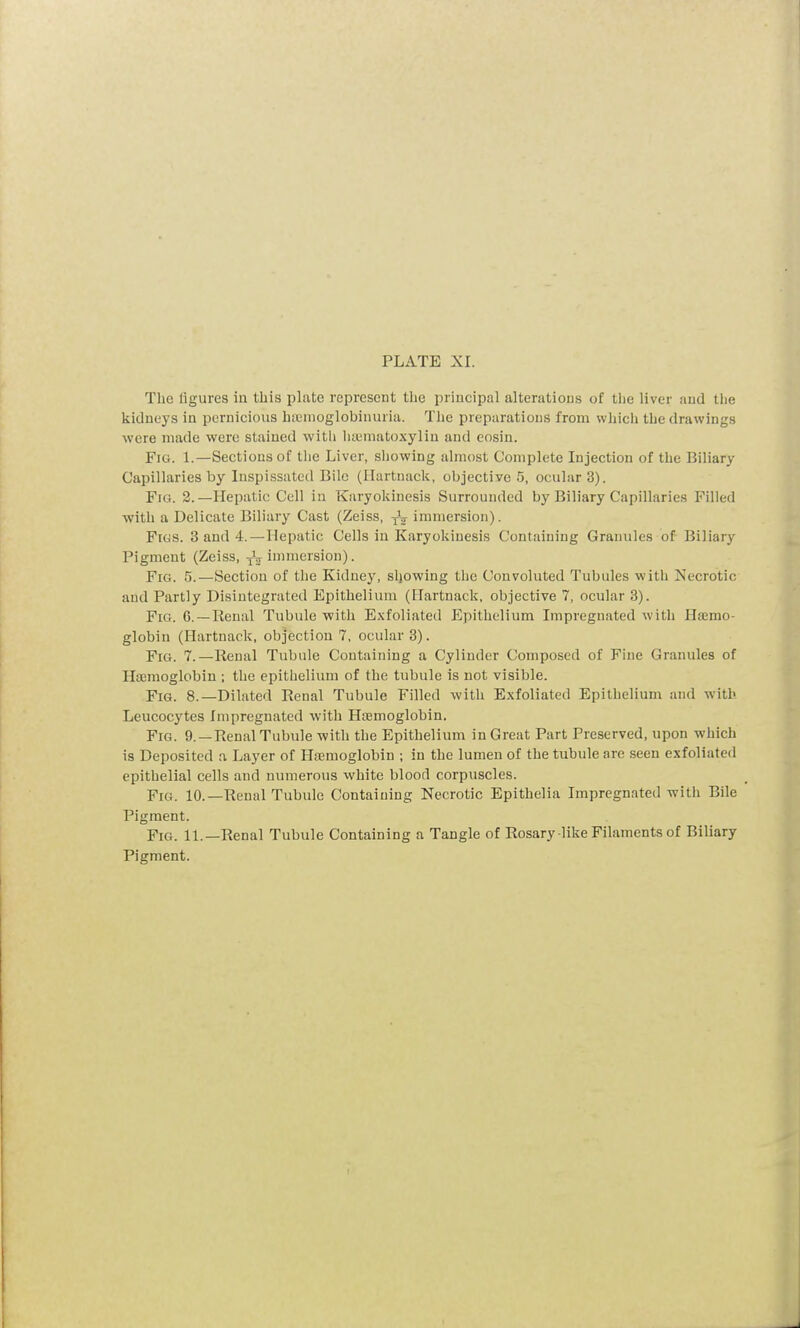 The figures in this plate represent the principal alterations of the liver and the kidneys in pernicious hsemoglobinuria. The preparations from which the drawings were made were stained with hematoxylin and eosin. Fig. 1.—Sections of the Liver, showing almost Complete Injection of the Biliary Capillaries by Inspissated Bile (Ilartuack, objective 5, ocular 3). Fig. 2.—Hepatic Cell in Karyokinesis Surrounded by Biliary Capillaries Filled with a Delicate Biliary Cast (Zeiss, TV immersion). Figs. 3 and 4. — Hepatic Cells in Karyokinesis Containing Granules of Biliary Pigment (Zeiss, TV immersion). Fig. 5.—Section of the Kidney, showing the Convoluted Tubules with Necrotic and Partly Disintegrated Epithelium (Hartnack, objective 7, ocular 3). Fig. G.~Renal Tubule with Exfoliated Epithelium Impregnated with Haemo- globin (Hartnack, objection 7, ocular 3). j?ig. 7.—Renal Tubule Containing a Cylinder Composed of Fine Granules of Haemoglobin ; the epithelium of the tubule is not visible. Fig. 8.—Dilated Renal Tubule Filled with Exfoliated Epithelium and with Leucocytes impregnated with Haemoglobin. Fig. 9. —Renal Tubule with the Epithelium in Great Part Preserved, upon which is Deposited a Layer of Haemoglobin ; in the lumen of the tubule are seen exfoliated epithelial cells and numerous white blood corpuscles. Fig. 10.—Renal Tubule Containing Necrotic Epithelia Impregnated with Bile Pigment. Fig. 11.—Renal Tubule Containing a Tangle of Rosary like Filaments of Biliary Pigment.