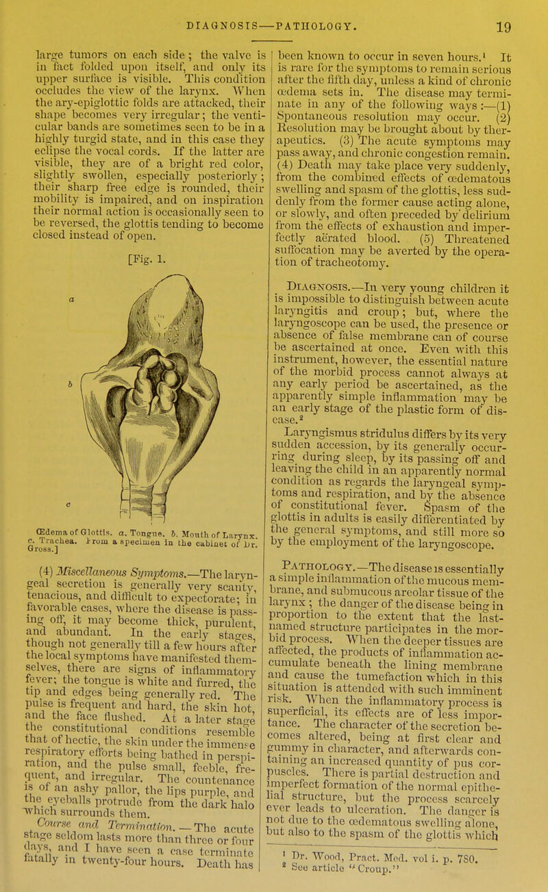 large tumors on each side ; the valve is in fact folded upon itself, and only its upper sui'face is visible. Tliis condition occludes the view of the larynx. AVhcn the ary-epiglottic folds are attacked, their shape becomes very irregular; the venti- cular bands are sometimes seen to be in a highly turgid state, and in this case they eclipse the vocal cords. If the latter are visible, they are of a bright red color, slightly swollen, especially posteriorly; their sharp free edge is rounded, their mobility is impaired, and on inspiration their normal action is occasionally seen to be reversed, the glottis tending to become closed instead of open. [Fig. 1. (Edema of Glottis, a. Tongne. 6. Month of Larynx c. Iriichea. iiom a specimen in the cabinet ot iir Gross.] (4) Iliscellaneous Symptoms.—The laryn- geal secretion is generally very scantv tenacious, and difficult to expectorate; in favorable cases, where the disease is pass- ing off, it may become thick, purulent and abundant. In the early stao-es' though not generally till a few hours after the local symptoms have manifested them- selves, there are signs of inflammatory fever; the tongue is white and furred the tip and edges being generally red. The pulse IS frequent and hard, the skin hot nnd the face flushed. At a later sta'-e the constitutional conditions resemble that of hectic, the skin under the immen'e respiratory efforts being batlied in persni- ration, and the pulse small, feeble, fre- quent, and irregular. The countenance IS of an ashy pallor, the lips purple, and the eyeballs protrude from the dark halo which surrounds them. Course and Trrmmntinn.—Tho acute stage seldom lasts more than three or four (lays and I have seen a case terminate fatally in twenty-four hours. Death has been known to occur in seven hours.' It is rare for the symptoms to remain serious after the lifth day, unless a kind of chronic (edema sets in. The disease may termi- nate in any of the following ways:—(1) Spontaneous resolution may occur. (2) Kesolution may be brought about by ther- apeutics. (3) The acute symptoms may pass away, and chronic congestion remain. (4) Death may take place very suddenly, from the combined effects of (^edematous swelling and spasm of the glottis, less sud- denly from the former cause acting alone, or slowly, and often preceded by' delirium from the effects of exhaustion and imper- fectly aerated blood. (5) Threatened suffocation may be averted by the opera- tion of tracheotomy. DrA(^NOSTS.—In very young children it is impossible to distinguish between acute laryngitis and croup; but, where the laryngoscope can be used, the presence or absence of false membrane can of course be ascertained at once. Even with this instrument, however, the essential nature of the morbid process cannot always at any early period be ascertained, as the apparently simple inflammation may be an early stage of the plastic form of dis- ease.* Laryngismus stridulus differs by its very sudden accession, by its generally occur- ring during sleep, by its passing off and leaving the child in an apparently normal condition as regards the laryngeal symp- toms and respiration, and by the absence of constitutional fever. Spasm of the glottis in adults is easily differentiated by the general symptoms, and still more so by the employment of the laryngoscope. Pathology. —The disease is essentially a simple inllaiumation of the mucous mem- brane, and submucous areolar tissue of the larynx ; the danger of tlie disease being in proportion to the extent that the last- named structure participates in the mor- bid process. When the deeper tissues are affected, the products of inflammation ac- cumulate beneath the lining membrane and cause the tumefaction which in this situation is attended with such imminent risk. When the inflammatory process is superficial, its effects are of less impor- tance. The character of the secretion be- comes altered, being at first clear and gummy in character, and afterwards con- taining an increased quantity of pus cor- puscles. There is partial destruction and imperfect formation of tlie normal epithe- lial structure, but the process scarcely ever leads to ulceration. The dancer is not due to the oedematous swelling alone, but also to the spasm of the glottis which ' Dr. Wood, Prnct. Mod. * fcJco article Croup. vol i. p. 7S0.