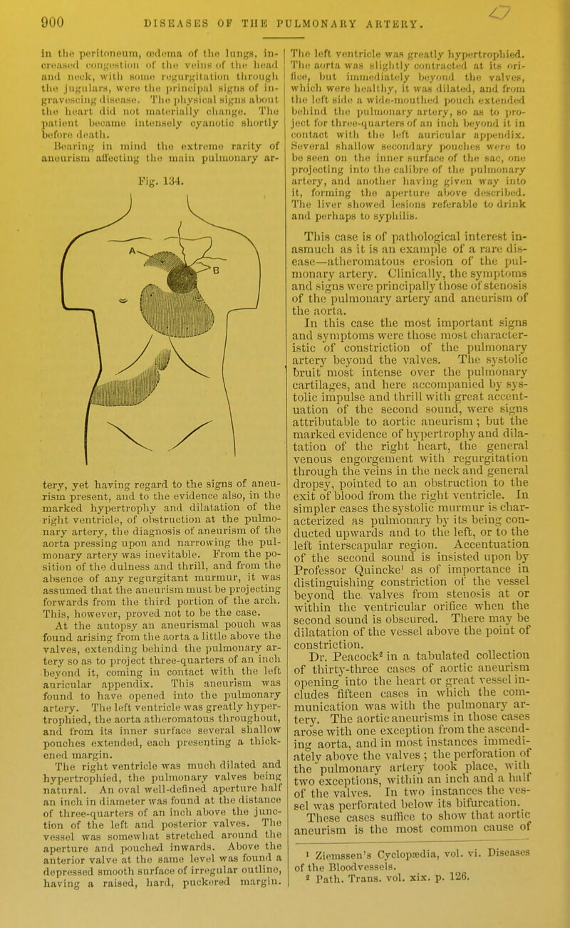 in the poritonoum, ooduma of tho lungs, in- croas(!(l coiigufition of tlio veins of Uic liciul and iiHck, witli Monio ru^urgitatiun thruugli till! jugiiliir.s, weru tho |irin(.'i])al signs of in- gravcrtciiig iliscaso. Tlii! piiysical nigns about tiio heart (lid not nialcrially cliaiigi!. Tiio ])atii-nl linoanio intmiscly cyanotic sliortly bi'lor(; (hNatli. Bo.'ii'iiig in mind tlio oxtromo rarity of auourisiu allbcting tin; ninin pulmonary ar- Fig. 134. tery, yet having regard to the signs of aneu- rism present, and to the evidence also, in the marked hypertrophy and dilatation of the right ventricle, of obstruction at the pulmo- nary artery, the diagnosis of aneurism of the aorta pressing upon and narrowing the pul- monary artery was inevitable. From the po- sition of the dulness and thrill, and from the absence of any regurgitant murmur, it was assumed that the aneurism must be projecting forwards from the third portion of the arch. This, however, proved not to be the case. At the autopsy an aneurismal pouch was found arising from the aorta a little above the valves, extending behind the pulmonary ar- tery so as to project three-quarters of an inch beyond it, coming in contact with the left auricular appendix. This aneurism was found to have opened into the pulmonary artery. The left ventricle was greatly hyper- trophied, the aorta atheromatous throughout, and from its inner surl'ace several shallow pouches extended, each presenting a thick- ened margin. The right ventricle was much dilated and hypertrophied, the pulmonary valves being natural. An oval well-defined aperture half an inch in diameter was found at the distance of three-quarters of an inch above the junc- tion of the left and posterior valves. Tho vessel was somewliat stretched around the aperture and pouche/1 inwards. Above tho anterior valve at the same level was found a depressed smooth surface of irregular outline, having a raised, hard, puckered margin. The left ventricle was greatly hypertrophied. Tlie aorta was siigiitly contracted at its ori- Hcft, but immediately beyond the valves, which were bealtiiy, it was dilated, and from the left side a wide-nioutlied poucli extended beliind tli(; iiuimonaiy artery, so as to jjro- j(!ct f(jr tliree-quartijrs of an incli beyond it in contact witli tiie left auricular appendix. Several shallow secondary pouches were to be seen on the inner surface of the sac, one projecting into the calibre of the pulmonary artery, ami anotlier having given way into it, forming tlio apfirture above described. The liver showed lesions referable to drink and perhaps to syphilis. Tlii8 case is of patliological interest in- asmuch as it is an exaniijle of a rare dis- ease—atiieromatouH erosion of the pul- monary artery. Clinically, the symptoms and signs were principally tliose of stenosis of the puhnonary artery and aneurism of the aorta. In this case the most important signs and syniptoms were those most character- istic of constriction of tlie puhnonary artery beyond the valves. The systolic bruit most intense over the puhnonary cartilages, and here accompanied by sys- tolic impulse and thrill with great accent- uation of the second sound, were signs attributal>le to aortic aneurism; but the marked evidence of hypertrophy and dila- tation of the right heart, the general venous engorgement with regurgitation through the veins in the neck and gener.al dropsy, pointed to an obstruction to the exit of blood from the right ventricle. In simpler cases the systolic murmur is char- acterized as pulmonary by its being con- ducted upwards and to the left, or to the left interscapular region. Accentuation of the second sound is insisted upon by Professor Quincke' as of importance in distinguishing constriction of the vessel beyond the. valves from stenosis at or within the ventricular orifice when the second sound is obscured. There may be dilatation of the vessel above the point of constriction. Dr. Peacock'' in a tabulated collection of thirty-three cases of aortic aneurism opening into the heart or great vessel in- cludes fifteen cases in which the com- munication was with the pulmonary ar- tery. The aortic aneurisms in those cases arose with one exception from the ascend- ing aorta, and in most instances immedi- ately above the valves ; the perforation of the pulmonary artery took place, with two exceptions, within an inch and a half of the valves. In two instances the ves- sel was perforated below its bifurcation. These cases suffice to shoAV that aortic aneurism is the most common cause of 1 Ziemssen's Cyclopedia, vol. vi. Diseases of the Bloodvessels.