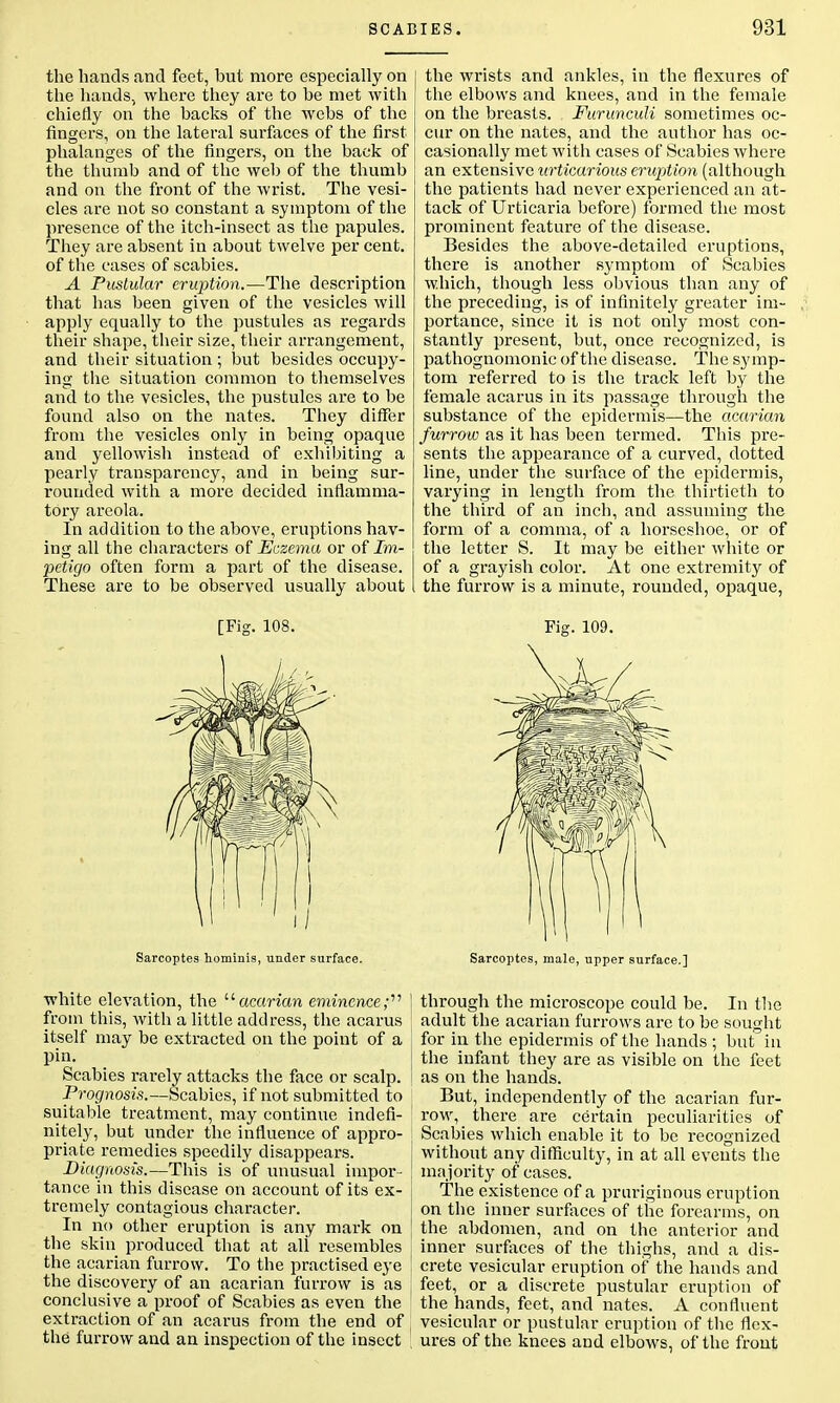 the hands and feet, but more especially on the hands, where they are to be met with chiefly on the backs of the webs of the fingers, on the lateral surfaces of the first phalanges of the fingers, on the back of the thumb and of the web of the thumb and on the front of the wrist. The vesi- cles are not so constant a symptom of the presence of the itch-insect as the papules. They are absent in about twelve per cent, of the cases of scabies. A Pustular eruption.—The description that has been given of the vesicles will apply equally to the pustules as regards their shape, their size, their arrangement, and their situation ; but besides occupy- ing the situation common to themselves and to the vesicles, the pustules are to be found also on the nates. They differ from the vesicles only in being opaque and yellowish instead of exhibiting a pearly transparency, and in being sur- rounded with a more decided inflamma- tory areola. In addition to the above, eruptions hav- ing all the characters of Eczema or of Im- petigo often form a part of the disease. These are to be observed usually about [Fig. 108. the wrists and ankles, in the flexures of the elbows and knees, and in the female on the breasts. Furunculi sometimes oc- cur on the nates, and the author has oc- casionally met with cases of Scabies where an extensive urticarious eruption (although the patients had never experienced an at- tack of Urticaria before) formed the most prominent feature of the disease. Besides the above-detailed eruptions, there is another symptom of Scabies which, though less obvious than any of the preceding, is of infinitely greater im- portance, since it is not only most con- stantly present, but, once recognized, is pathognomonic of the disease. The symp- tom referred to is the track left by the female acarus in its passage through the substance of the epidermis—the acarian furrow as it has been termed. This pre- sents the appearance of a curved, dotted line, under the surface of the epidermis, varying in length from the thirtieth to the third of an inch, and assuming the form of a comma, of a horseshoe, or of the letter S. It may be either white or of a grayish color. At one extremity of the furrow is a minute, rounded, opaque, Fig. 109. Sarcoptes hominis, under surface. Sarcoptes, male, upper surface.] white elevation, the acarian eminence;'''' from this, with a little address, the acarus itself may be extracted on the point of a pin. Scabies rarely attacks the face or scalp. Prognosis.—Scabies, if not submitted to suitable treatment, may continue indefi- nitely, but under the influence of appro- priate remedies speedily disappears. Diagnosis.—This is of unusual impor- tance in this disease on account of its ex- tremely contagious character. In no other eruption is any mark on the skin produced that at ali resembles the acarian furrow. To the practised eye the discovery of an acarian furrow is as conclusive a proof of Scabies as even the extraction of an acarus from the end of the furrow and an inspection of the insect through the microscope could be. In the adult the acarian furrows are to be sought for in the epidermis of the hands ; but in the infant they are as visible on the feet as on the hands. But, independently of the acarian fur- row, there are certain peculiarities of Scabies which enable it to be recognized without any difficulty, in at all events the majority of cases. The existence of a pruriginous eruption on the inner surfaces of the forearms, on the abdomen, and on the anterior and inner surfaces of the thighs, and a dis- crete vesicular eruption of the hands and feet, or a discrete pustular eruption of the hands, feet, and nates. A confluent vesicular or pustular eruption of the flex- ures of the knees and elbows, of the front