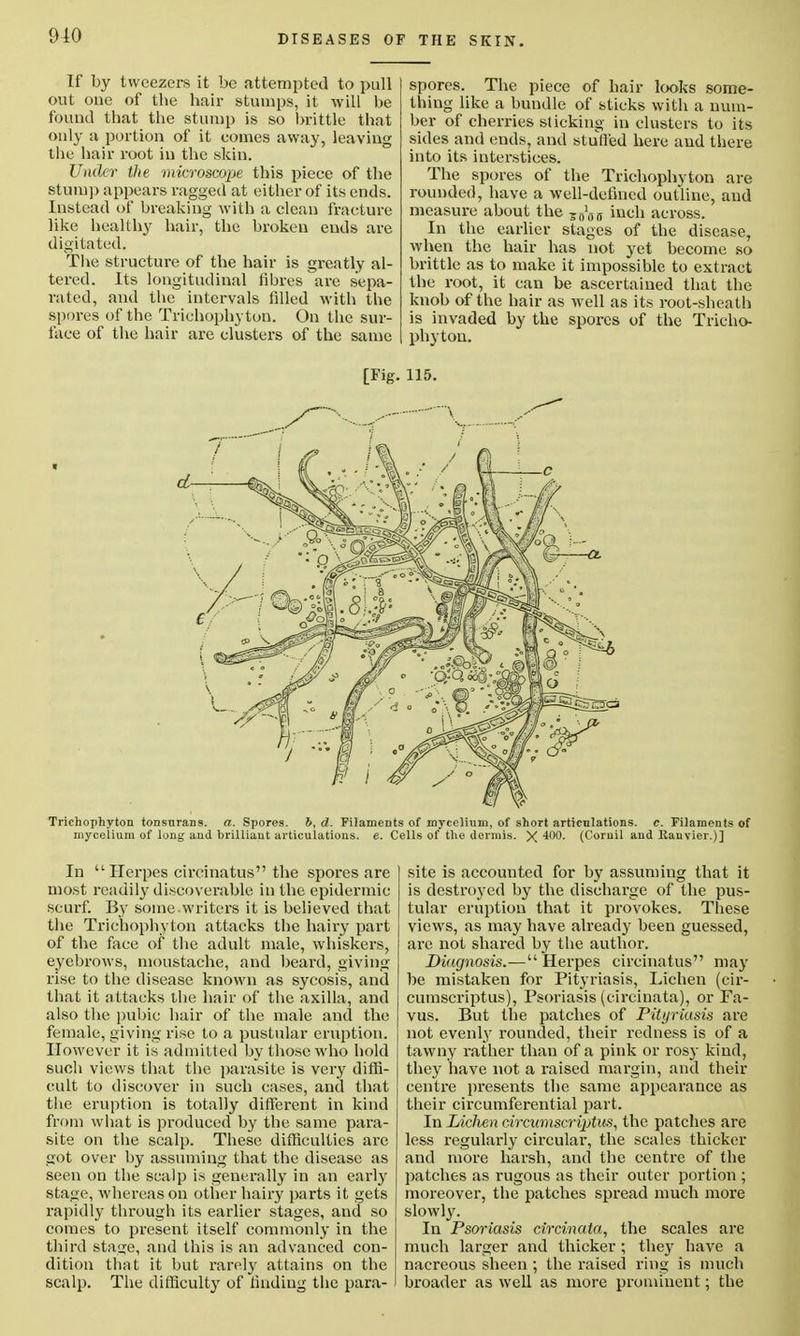 910 If by tweezers it be attempted to pull out one of the hair stumps, it will be found that the stump is so brittle that only a portion of it comes away, leaving the hair root in the skin. Under the microscope this piece of the stump appears ragged at either of its ends. Instead of breaking with a clean fracture like healthy hair, the broken ends are digitated. The structure of the hair is greatly al- tered. Its longitudinal fibres are sepa- rated, and the intervals filled with the spores of the Trichophyton. On the sur- face of the hair are clusters of the same spores. The piece of hair looks some- thing like a bundle of sticks with a num- ber of cherries slicking in clusters to its sides and ends, and stuffed here and there into its interstices. The spores of the Trichophyton are rounded, have a well-defined outline, and measure about the iich across. In the earlier stages of the disease, when the hair has not yet become so brittle as to make it impossible to extract the root, it can be ascertained that the knob of the hair as well as its root-sheath is invaded by the spores of the Tricho- phyton. [Fig. 115. Trichophyton tonsurans, a. Spores. d. Filaments of mycelium, of short articulations, c. Filaments of mycelium of long and brilliant articulations, e. Cells of the dermis. X 400. (Coruil and Ranvier.)] In  Herpes circinatus the spores are most readily discoverable in the epidermic scurf. By some writers it is believed that the Trichophyton attacks the hairy part of the face of the adult male, whiskers, eyebrows, moustache, and beard, giving rise to the disease known as sycosis, and that it attacks the hair of the axilla, and also the pubic hair of the male and the female, giving rise to a pustular eruption. However it is admitted by those who hold such views that the parasite is very diffi- cult to discover in such cases, and that the eruption is totally different in kind from what is produced by the same para- site on the scalp. These difficulties are got over by assuming that the disease as seen on the scalp is generally in an early stage, whereas on other hairy parts it gets rapidly through its earlier stages, and so comes to present itself commonly in the third sta<;e, and this is an advanced con- dition that it but rarely attains on the scalp. The difficulty of finding the para- site is accounted for by assuming that it is destroyed by the discharge of the pus- tular eruption that it provokes. These views, as may have already been guessed, are not shared by the author. Diagnosis.— Herpes circinatus may be mistaken for Pityriasis, Lichen (cir- cumscriptus), Psoriasis (circinata), or Fa- vus. But the patches of Pityriasis are not evenly rounded, their redness is of a tawny rather than of a pink or rosy kind, they have not a raised margin, and their centre presents the same appearance as their circumferential part. In Lichen circumscriptus, the patches are less regularly circular, the scales thicker and more harsh, and the centre of the patches as rugous as their outer portion ; moreover, the patches spread much more slowly. In Psoriasis circinata, the scales are much larger and thicker; they have a nacreous sheen; the raised ring is much broader as well as more prominent; the