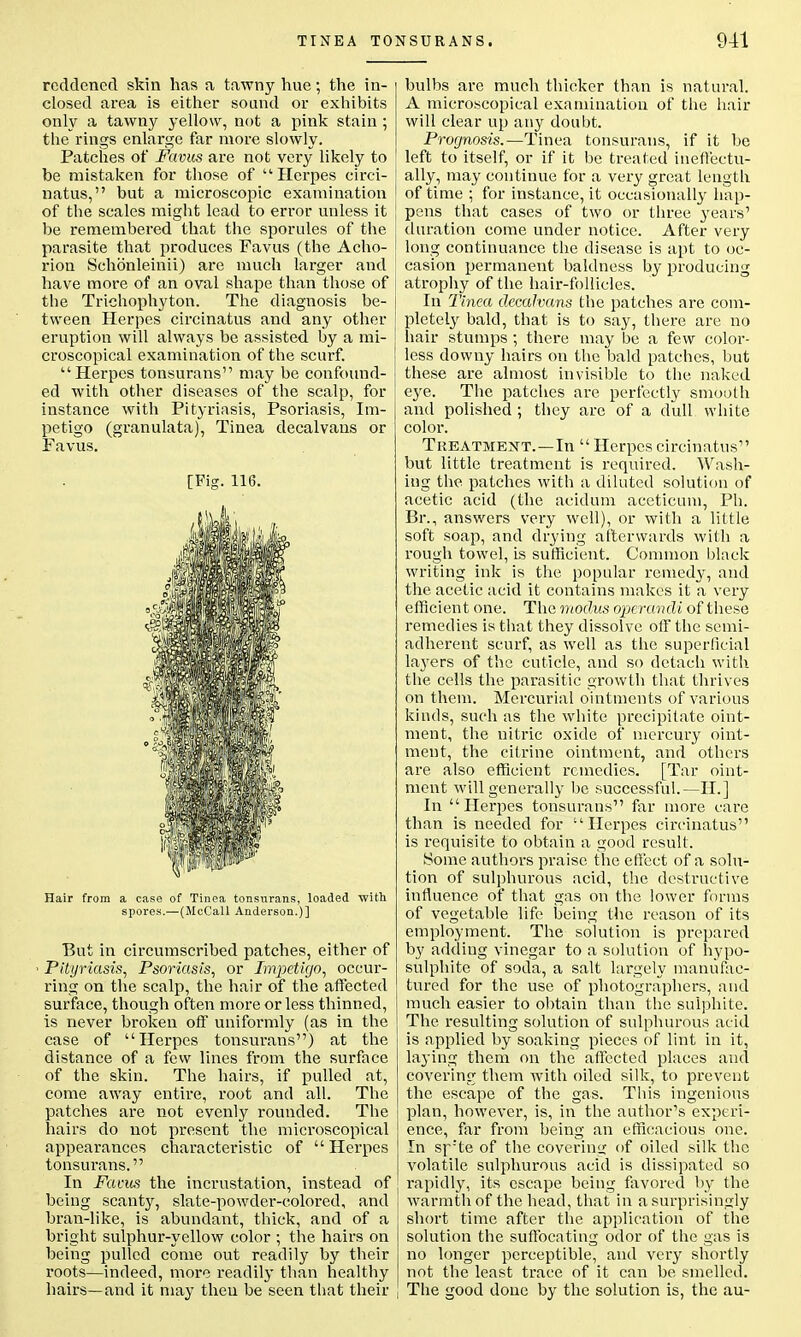 reddened skin has a tawny hue; the in- closed area is either sound or exhibits only a tawny yellow, not a pink stain ; the rings enlarge far more slowly. Patches of Favus are not very likely to be mistaken for those of Herpes circi- natus, but a microscopic examination of the scales might lead to error unless it be remembered that the sporules of the parasite that produces Favus (the Acho- rion Schoenleinii) are much larger and have more of an oval shape than those of the Trichophyton. The diagnosis be- tween Herpes circinatus and any other eruption will always be assisted by a mi- croscopical examination of the scurf. Herpes tonsurans may be confound- ed with other diseases of the scalp, for instance with Pityriasis, Psoriasis, Im- petigo (granulata), Tinea decalvaus or Favus. [Fig. 116. Hair from a case of Tinea tonsurans, loaded 'with spores.—(McCall Anderson.)] But in circumscribed patches, either of Pityriasis, Psoriasis, or Impetigo, occur- ring on the scalp, the hair of the affected surface, though often more or less thinned, is never broken off uniformly (as in the case of Herpes tonsurans) at the distance of a few lines from the surface of the skin. The hairs, if pulled at, come away entire, root and all. The patches are not evenly rounded. The hairs do not present the microscopical appearances characteristic of  Herpes tonsurans. In Funis the incrustation, instead of being scanty, slate-powder-colored, and bran-like, is abundant, thick, and of a bright sulphur-yellow color ; the hairs on being pulled come out readily by their roots—indeed, more readily than healthy hairs—and it may then be seen that their bulbs are much thicker than is natural. A microscopical examination of the hair will clear up any doubt. Prognosis.—Tinea tonsurans, if it be left to itself, or if it be treated ineffectu- ally, may continue for a very great length of time ; for instance, it occasionally hap- pens that cases of two or three years1 duration come under notice. After very long continuance the disease is apt to oc- casion permanent baldness by producing atrophy of the hair-follicles. In Tinea decalvans the patches are com- pletely bald, that is to say, there are no hair stumps ; there may be a few color- less downy hairs on the bald patches, but these are almost invisible to the naked eye. The patches are perfectly smooth and polished ; they are of a dull white color. Treatment.—In  Herpes circinatus but little treatment is required. Wash- ing the patches with a diluted solution of acetic acid (the acidum aceticum, Ph. Br., answers very well), or with a little soft soap, and drying afterwards with a rough towel, is sufficient. Common black writing ink is the popular remedy, and the acetic acid it contains makes it a very efficient one. The modus operandi of these remedies is that they dissolve off the semi- adherent scurf, as well as the superlicial layers of the cuticle, and so detach with the cells the parasitic growth that thrives on them. Mercurial ointments of various kinds, such as the white precipitate oint- ment, the nitric oxide of' mercury oint- ment, the citrine ointment, and others are also efficient remedies. [Tar oint- ment will generally be successful.—II.] In Herpes tonsurans far more care than is needed for Herpes circinatus is requisite to obtain a good result. Some authors praise the effect of a solu- tion of sulphurous acid, the destructive influence of that gas on the lower forms of vegetable life being the reason of its employment. The solution is prepared by adding vinegar to a solution of hypo- sulphite of soda, a salt largely manufac- tured for the use of photographers, and much easier to obtain than the sulphite. The resulting solution of sulphurous acid is applied by soaking pieces of lint in it, laying them on the affected places and covering them with oiled silk, to prevent the escape of the gas. This ingenious plan, however, is, in the author's experi- ence, far from being an efficacious one. In sr:te of the covering of oiled silk the volatile sulphurous acid is dissipated so rapidly, its escape being favored by the warmth of the head, that in a surprisingly short time after the application of the solution the suffocating odor of the gas is no longer perceptible, and very shortly not the least trace of it can be smellcd. The good done by the solution is, the au-