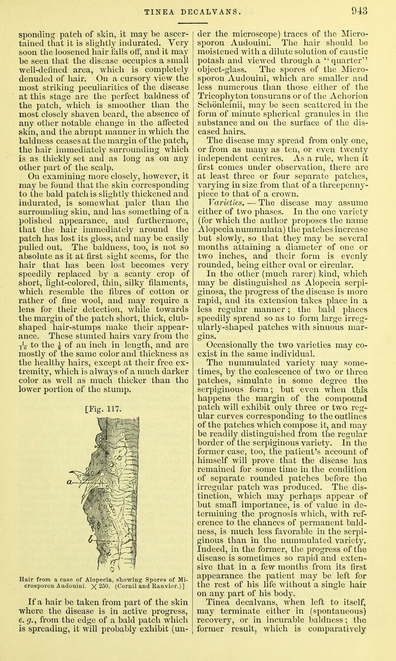 sponding patch of skin, it may be ascer- tained that it is slightly indurated. Very soon the loosened hair falls oft* and it may be seen that the disease occupies a small well-defined area, which is completely denuded of hair. On a cursory view the most striking peculiarities of the disease at this stage are the perfect baldness of the patch, which is smoother than the most closely shaven beard, the absence of any other notable change in the affected skin, and the abrupt manner in which the baldness ceases at the margin of the patch, the hair immediately surrounding which is as thickly set and as long as on any other part of the scalp. On examining more closely, however, it may be found that the skin corresponding to the bald patch is slightly thickened and indurated, is somewhat paler than the surrounding skin, and has something of a polished appearance, and furthermore, that the hair immediately around the patch has lost its gloss, and may be easily pulled out. The baldness, too, is not so absolute as it at first sight seems, for the hair that has been lost becomes very speedily replaced by a scanty crop of short, light-colored, thin, silky filaments, which resemble the fibres of cotton or rather of fine wool, and may require a lens for their detection, while towards the margin of the patch short, thick, club- shaped hair-stumps make their appear- ance. These stunted hairs vary from the T'ff to the £ of an inch in length, and are mostly of the same color and thickness as the healthy hairs, except at their free ex- tremity, which is always of a much darker color as well as much thicker than the lower portion of the stump. [Fig. 117. Hair from a case of Alopecia, showing Spores of Mi- crosporon Audouini. X 250. (Cornil and Ranvier.)] If a hair be taken from part of the skin where the disease is in active progress, e. g., from the edge of a bald patch which is spreading, it will probably exhibit (un- der the microscope) traces of the Miero- sporon Audouini. The hair should be moistened with a dilute solution of caustic potash and viewed through a t; quarter object-glass. The spores of the Micro- sporon Audouini, which are smaller and less numerous than those either of the Tricophy ton tonsurans or of the Achorion Schonleinii, may be seen scattered in the form of minute spherical granules in the substance and on the surface of the dis- eased hairs. The disease may spread from only one, or from as many as ten, or even twenty independent centres. As a rule, when it first comes under observation, there arc at least three or four separate patches, varying in size from that of a threepenny- piece to that of a crown. Varieties. — The disease may assume either of two phases. In the one variety (for which the author proposes the name Alopecia nummulata) the patches increase but slowly, so that they may be several months attaining a diameter of one or two inches, and their form is evenly rounded, being either oval or circular. In the other (much rarer) kind, which may be distinguished as Alopecia serpi- ginosa, the progress of the disease is more rapid, and its extension takes place in a less regular manner; the bald places speedily spread so as to form large irreg- ularly-shaped patches with sinuous mar- gins. Occasionally the two varieties may co- exist in the same individual. The nummulated variety may some- times, by the coalescence of two or three patches, simulate in some degree the serpiginous form; but even when this happens the margin of the compound patch will exhibit only three or two reg- ular curves corresponding to the outlines of the patches which compose it, and may be readily distinguished from the regular border of the serpiginous variety. In the former case, too, the patient's account of himself will prove that the disease has remained for some time in the condition of separate rounded patches before the irregular patch was produced. The dis- tinction, which may perhaps appear of but small importance, is of value in de- termining the prognosis which, with ref- erence to the chances of permanent bald- ness, is much less favorable in the serpi- ginous than in the nummulated variety. Indeed, in the former, the progress of the disease is sometimes so rapid and exten- sive that in a few months from its first appearance the patient may be left for the rest of his life without a single hair on any part of his body. Tinea decalvans, when left to itself, may terminate either in (spontaneous) recovery, or in incurable baldness; the former result, which is comparatively