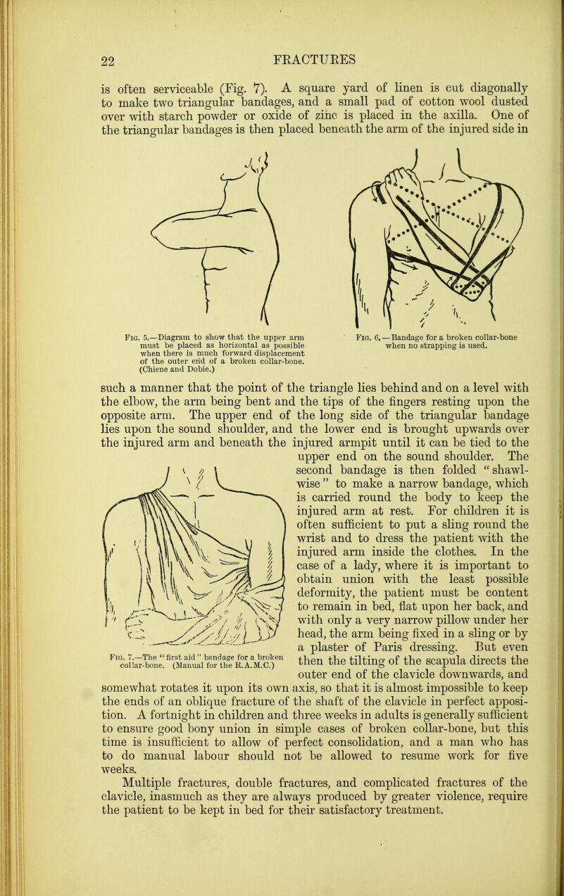 is often serviceable (Fig. 7). A square yard of linen is cut diagonally to make two triangular bandages, and a small pad of cotton wool dusted over with starch powder or oxide of zinc is placed in the axilla. One of the triangular bandages is then placed beneath the arm of the injured side in Fig. 5.—Diagram to show that the upper arm must be placed as horizontal as possible when there is much forward displacement of the outer end of a broken collar-bone. (Ohiene and Dobie.) Fig. ,—Bandage for a broken collar-bone when no strapping is used. such a manner that the point of the triangle lies behind and on a level with the elbow, the arm being bent and the tips of the fingers resting upon the opposite arm. The upper end of the long side of the triangular bandage lies upon the sound shoulder, and the lower end is brought upwards over the injured arm and beneath the injured armpit until it can be tied to the upper end on the sound shoulder. The second bandage is then folded shawl- wise  to make a narrow bandage, which is carried round the body to keep the injured arm at rest. For children it is often sufficient to put a sling round the wrist and to dress the patient with the injured arm inside the clothes. In the case of a lady, where it is important to obtain union with the least possible deformity, the patient must be content to remain in bed, flat upon her back, and with only a very narrow pillow under her head, the arm being fixed in a sling or by a plaster of Paris dressing. But even then the tilting of the scapula directs the outer end of the clavicle downwards, and somewhat rotates it upon its own axis, so that it is almost impossible to keep the ends of an oblique fracture of the shaft of the clavicle in perfect apposi- tion. A fortnight in children and three weeks in adults is generally sufficient to ensure good bony union in simple cases of broken collar-bone, but this time is insufficient to allow of perfect consolidation, and a man who has to do manual labour should not be allowed to resume work for five weeks. Multiple fractures, double fractures, and complicated fractures of the clavicle, inasmuch as they are always produced by greater violence, require the patient to be kept in bed for their satisfactory treatment. Fig. 7.—The  first aid  bandage for a broken collar-bone. (Manual for the R.A.M.C.)