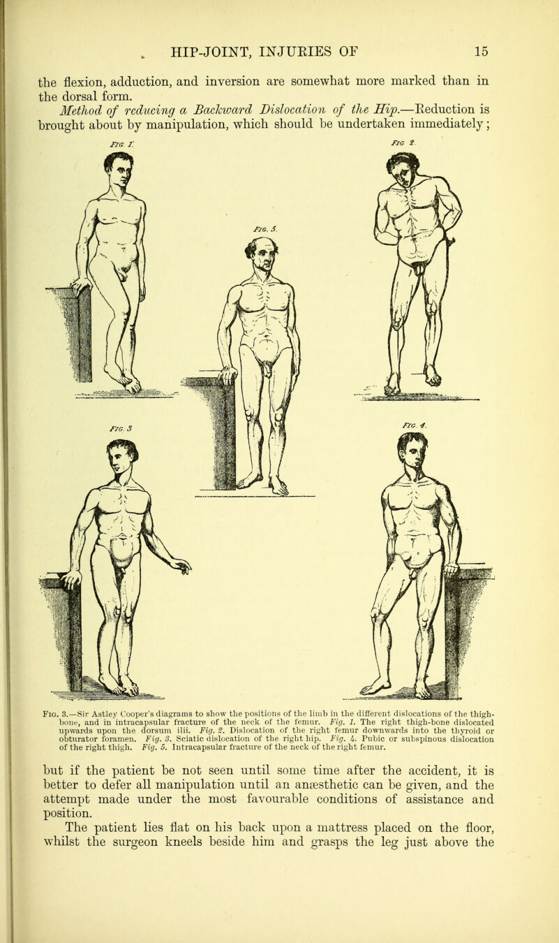the flexion, adduction, and inversion are somewhat more marked than in the dorsal form. Method of reducing a Backward Dislocation of the Hip.—Eeduction is brought about by manipulation, which should be undertaken immediately; tig i: no 2 Fig. 3.—Sir Astley Cooper's diagrams to show the positions of the limb in the different dislocations of the thigh- bone, and in intracapsular fracture of the neck of the femur. Fig. 1. The right thigh-bone dislocated upwards upon the dorsum ilii. Fig. 2. Dislocation of the right femur downwards into the thyroid or obturator foramen. Fig. 3. Sciatic dislocation of the right hip. Fig. h- Pubic or subspinous dislocation of the right thigh. Fig. 5. Intracapsular fracture of the neck of the right femur. but if the patient be not seen until some time after the accident, it is better to defer all manipulation until an anaesthetic can be given, and the attempt made under the most favourable conditions of assistance and position. The patient lies flat on his back upon a mattress placed on the floor, whilst the surgeon kneels beside him and grasps the leg just above the