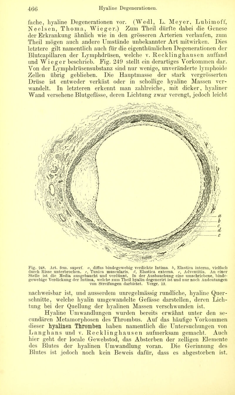 fache, hyaline Degenerationen vor. (Wedl, L. Meyer, Lubimoff, Ne eisen, Thoma, Wieger.) Zum Theil dürfte dabei die Genese der Erkrankung ähnlich wie in den grösseren Arterien verlaufen, zum Theil mögen auch andere Umstände unbekannter Art mitwirken. Dies letztere gilt namentlich auch für die eigentümlichen Degenerationen der Blutcapillaren der Lymphdrüsen, welche v. Mecklinghausen auffand und Wieg er beschrieb. Fig. 249 stellt ein derartiges Vorkommen dar. Von der Lymphdrüsensubstanz sind nur wenige, unveränderte lymphoide Zellen übrig geblieben. Die Hauptmasse der stark vergrösserten Drüse ist entweder verkäst oder in schollige hyaline Massen ver- wandelt. In letzteren erkennt man zahlreiche, mit dicker, hyaliner Wand versehene Blutgefässe, deren Lichtung zwar verengt, jedoch leicht Fig. 248. Art. fem. superf. a, diffus bindegewebig verdickte Intima. b, Elastica interna, vielfach durch Risse unterbrochen, e, Tunica muscularis. ä, Elastica externa, e, Adventitia. An einer Stelle ist die Media ausgebaucht und verdünnt. In der Ausbauchung eine umschriebene, binde- gewebige Verdickung der Intima, welche zum Theil hyalin degenerirt ist und nur noch Andeutungen von Streifungen darbietet. Vergr. 12. nachweisbar ist, und ausserdem unregelmässig rundliche, hyaline Quer- schnitte, welche hyalin umgewandelte Gefässe darstellen, deren Lich- tung bei der Quellung der hyalinen Massen verschwunden ist. Hyaline Umwandlungen wurden bereits erwähnt unter den se- cundären Metamorphosen des Thrombus. Auf das häufige Vorkommen dieser hyalinen Thromben haben namentlich die Untersuchungen von Langhans und v. Recklinghausen aufmerksam gemacht. Auch hier geht der locale Gewebstod, das Absterben der zelligen Elemente des Blutes der hyalinen Umwandlung voran. Die Gerinnung des Blutes ist jedoch noch kein Beweis dafür, dass es abgestorben ist.