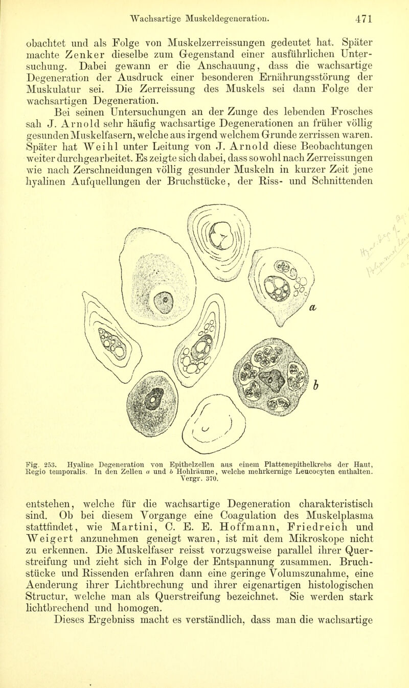 obaclitet und als Folge von Muskelzerreissungen gedeutet hat. Später machte Zenker dieselbe zum Gegenstand einer ausführlichen Unter- suchung. Dabei gewann er die Anschauung, dass die wachsartige Degeneration der Ausdruck einer besonderen Ernährungsstörung der Muskulatur sei. Die Zerreissung des Muskels sei dann Folge der wachsartigen Degeneration. Bei seinen Untersuchungen an der Zunge des lebenden Frosches sah J. Arnold sehr häufig wachsartige Degenerationen an früher völlig gesunden Muskelfasern, welche aus irgend welchem Grunde zerrissen waren. Später hat Weihl unter Leitung von J. Arnold diese Beobachtungen weiter durchgearbeitet. Es zeigte sich dabei, dass sowohl nach Zerreissungen wie nach Zerschneidungen völlig gesunder Muskeln in kurzer Zeit jene hyalinen Aufquellungen der Bruchstücke, der Eiss- und Schnittenden Fig. 253. Hyaline Degeneration von Epithelzellen aus einem Plattenepithelkrebs der Haut, Regio temporalis. In den Zellen a und b Hohlräume, welche mehrkernige Leucocyten enthalten. Vergr. 370. entstehen, welche für die wachsartige Degeneration charakteristisch sind. Ob bei diesem Vorgänge eine Coagulation des Muskelplasma stattfindet, wie Martini, C. E. E. Hoffmann, Friedreich und Weigert anzunehmen geneigt waren, ist mit dem Mikroskope nicht zu erkennen. Die Muskelfaser reisst vorzugsweise parallel ihrer Quer- streifung und zieht sich in Folge der Entspannung zusammen. Bruch- stücke und Bissenden erfahren dann eine geringe Volumszunahme, eine Aenderung ihrer Lichtbrechung und ihrer eigenartigen histologischen Structur, welche man als Querstreifung bezeichnet. Sie werden stark lichtbrechend und homogen. Dieses Ergebniss macht es verständlich, dass man die wachsartige