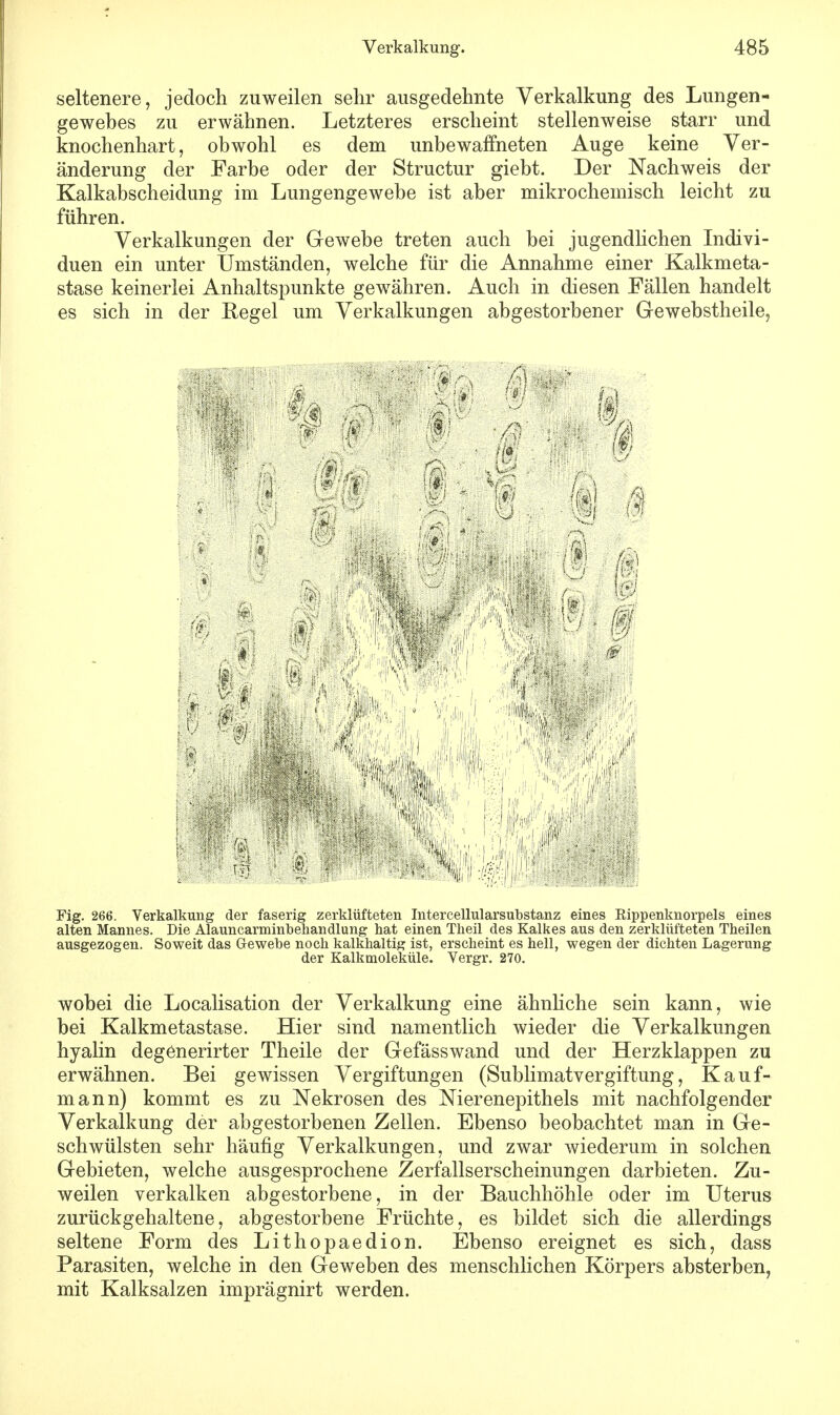 seltenere, jedoch zuweilen sehr ausgedehnte Verkalkung des Lungen- gewebes zu erwähnen. Letzteres erscheint stellenweise starr und knochenhart, obwohl es dem unbewaffneten Auge keine Ver- änderung der Farbe oder der Structur giebt. Der Nachweis der Kaikabscheidung im Lungengewebe ist aber mikrochemisch leicht zu führen. Verkalkungen der Gewebe treten auch bei jugendlichen Indivi- duen ein unter Umständen, welche für die Annahme einer Kalkmeta- stase keinerlei Anhaltspunkte gewähren. Auch in diesen Fällen handelt es sich in der Regel um Verkalkungen abgestorbener Gewebstheile, Fig. 266. Verkalkung der faserig zerklüfteten Intercellularsubstanz eines Rippenknorpels eines alten Mannes. Die Alauncarminbehandlung hat einen Theil des Kalkes aus den zerklüfteten Theilen ausgezogen. Soweit das Gewebe noch kalkhaltig ist, erscheint es hell, wegen der dichten Lagerung der Kalkmoleküle. Vergr. 270. wobei die Localisation der Verkalkung eine ähnliche sein kann, wie bei Kalkmetastase. Hier sind namentlich wieder die Verkalkungen hyalin degenerirter Theile der Gefässwand und der Herzklappen zu erwähnen. Bei gewissen Vergiftungen (Sublimatvergiftung, Kauf- mann) kommt es zu Nekrosen des Nierenepithels mit nachfolgender Verkalkung der abgestorbenen Zellen. Ebenso beobachtet man in Ge- schwülsten sehr häufig Verkalkungen, und zwar wiederum in solchen Gebieten, welche ausgesprochene Zerfallserscheinungen darbieten. Zu- weilen verkalken abgestorbene, in der Bauchhöhle oder im Uterus zurückgehaltene, abgestorbene Früchte, es bildet sich die allerdings seltene Form des Lithopaedion. Ebenso ereignet es sich, dass Parasiten, welche in den Geweben des menschlichen Körpers absterben, mit Kalksalzen imprägnirt werden.