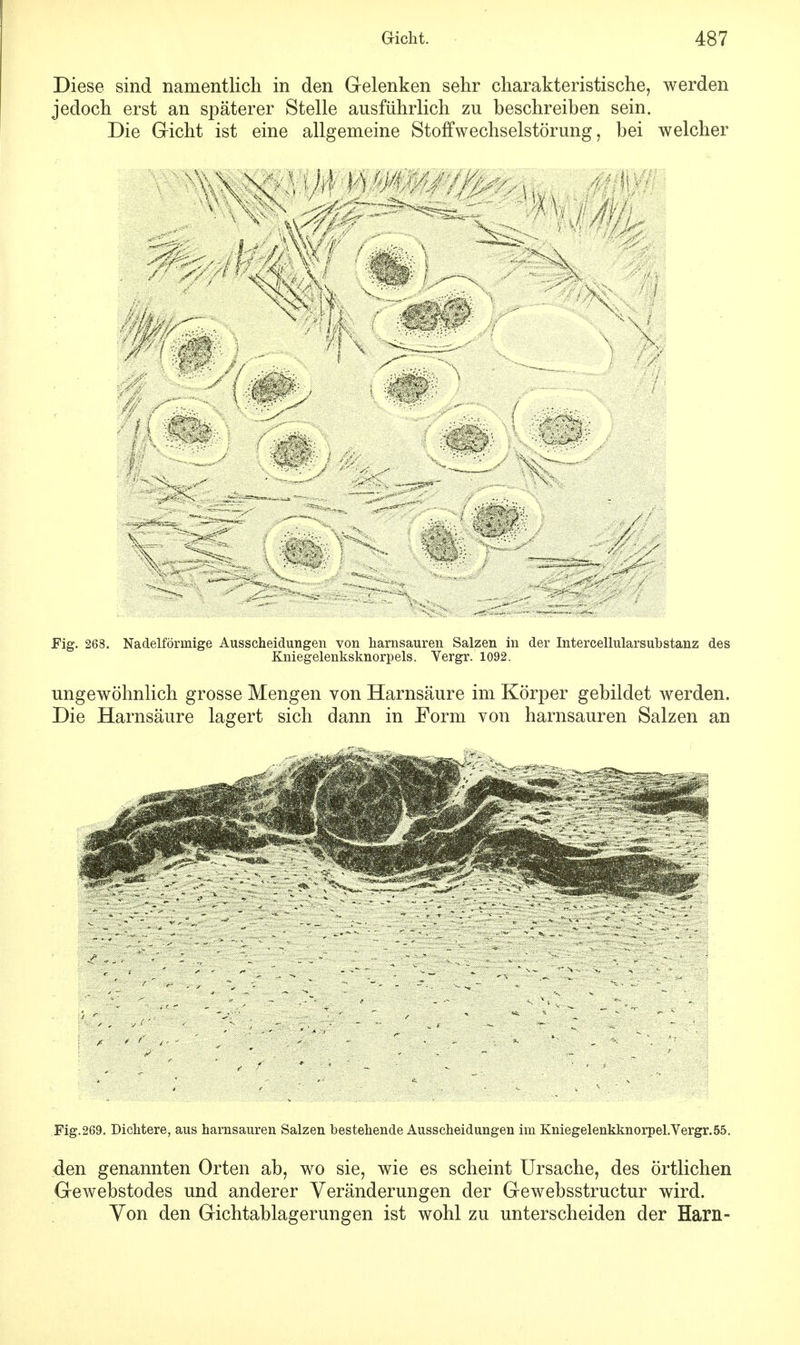Diese sind namentlich in den Gelenken sehr charakteristische, werden jedoch erst an späterer Stelle ausführlich zu beschreiben sein. Die Gicht ist eine allgemeine Stoffwechselstörung, bei welcher y« ^ X ( 1/j . \ \ v ' ■ y^J • ■ ik : \\ - *$yisß // ■ / $ i Fig. 263. Nadelförmige Ausscheidungen von harnsauren Salzen in der Intercellularsubstanz des Kniegelenksknorpels. Vergr. 1092. ungewöhnlich grosse Mengen von Harnsäure im Körper gebildet werden. Die Harnsäure lagert sich dann in Form von harnsauren Salzen an Fig.269. Dichtere, aus harnsauren Salzen bestehende Ausscheidungen im Kniegelenkknorpel.Vergr.55. den genannten Orten ab, wo sie, wie es scheint Ursache, des örtlichen Gewebstodes und anderer Veränderungen der Gewebsstructur wird. Von den Gichtablagerungen ist wohl zu unterscheiden der Harn-