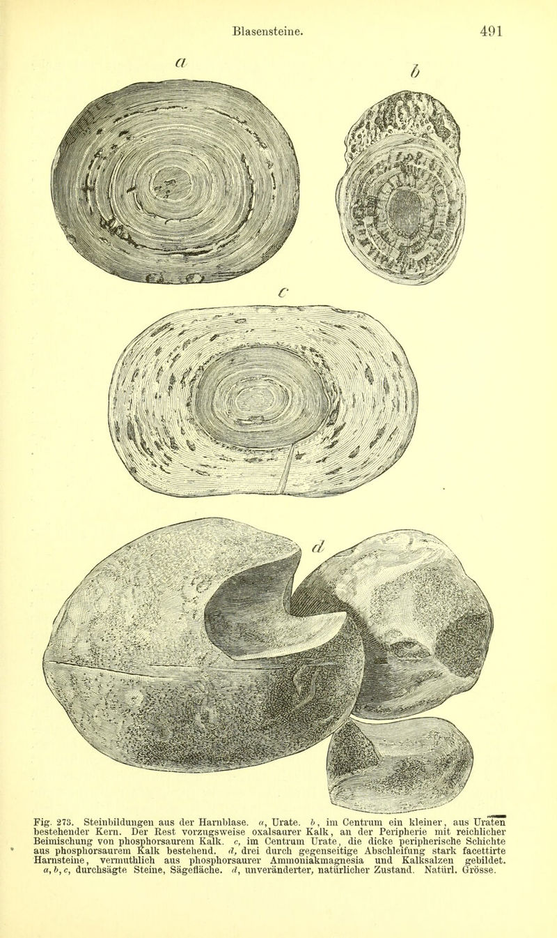 Fig. 273. Steinbildungen aus der Harnblase, a, Urate. b, im Centrum ein kleiner, aus Uraten bestehender Kern. Der Rest vorzugsweise oxalsaurer Kalk, an der Peripherie mit reichlicher Beimischung von phosphorsaurem Kalk, c, im Centram Urate, die dicke peripherische Schichte aus phosphorsaurem Kalk bestehend, ä, drei durch gegenseitige Abschleifung stark facettirte Harnsteine, vermuthlich aus phosphorsaurer Ammoniakmagnesia und Kalksalzen gebildet. a,b,c, durchsägte Steine, Sägefläche, d, unveränderter, natürlicher Zustand. Natürl. Grösse.