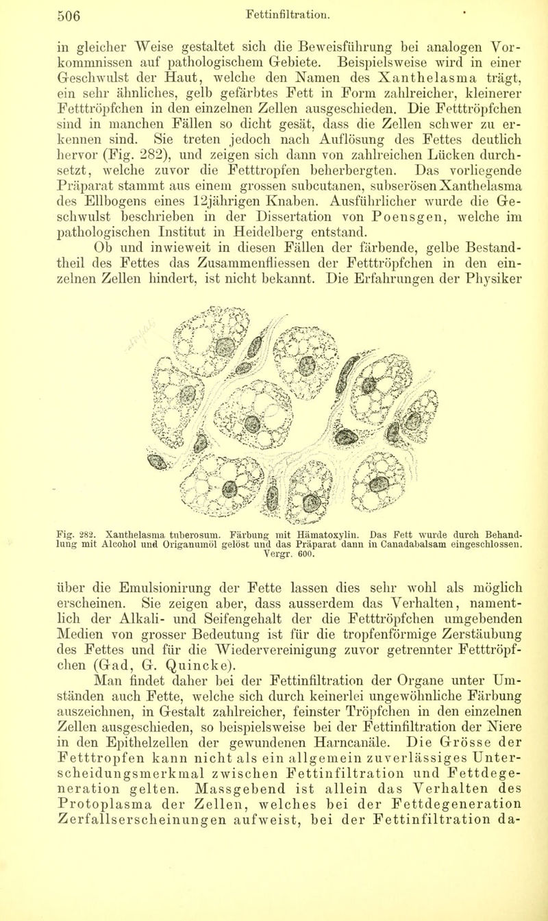 in gleicher Weise gestaltet sich die Beweisführung bei analogen Vor- kommnissen auf pathologischem Gebiete. Beispielsweise wird in einer Geschwulst der Haut, welche den Namen des Xanthelasma trägt, ein sehr ähnliches, gelb gefärbtes Fett in Form zahlreicher, kleinerer Fetttröpfchen in den einzelnen Zellen ausgeschieden. Die Fetttröpfchen sind in manchen Fällen so dicht gesät, dass die Zellen schwer zu er- kennen sind. Sie treten jedoch nach Auflösung des Fettes deutlich hervor (Fig. 282), und zeigen sich dann von zahlreichen Lücken durch- setzt, welche zuvor die Fetttropfen beherbergten. Das vorliegende Präparat stammt aus einem grossen subcutanen, subserösen Xanthelasma des Ellbogens eines 12jährigen Knaben. Ausführlicher wurde die Ge- schwulst beschrieben in der Dissertation von Poensgen, welche im pathologischen Institut in Heidelberg entstand. Ob und inwieweit in diesen Fällen der färbende, gelbe Bestand- teil des Fettes das Zusammenfliessen der Fetttröpfchen in den ein- zelnen Zellen hindert, ist nicht bekannt. Die Erfahrungen der Physiker Fig. 282. Xanthelasma tuberosum. Färbung mit Hämatoxylin. Das Fett wurde durch Behand- lung mit Alcohol und Origanumöl gelöst und das Präparat dann in Canadabalsam eingeschlossen. Vergr. 600. über die Emulsionirung der Fette lassen dies sehr wohl als möglich erscheinen. Sie zeigen aber, dass ausserdem das Verhalten, nament- lich der Alkali- und Seifengehalt der die Fetttröpfchen umgebenden Medien von grosser Bedeutung ist für die tropfenförmige Zerstäubung des Fettes und für die Wiedervereinigung zuvor getrennter Fetttröpf- chen (Gad, G. Quincke). Man findet daher bei der Fettinfiltration der Organe unter Um- ständen auch Fette, welche sich durch keinerlei ungewöhnliche Färbung auszeichnen, in Gestalt zahlreicher, feinster Tröpfchen in den einzelnen Zellen ausgeschieden, so beispielsweise bei der Fettinfiltration der Xiere in den Epithelzellen der gewundenen Harncanäle. Die Grösse der Fetttropfen kann nicht als ein allgemein zuverlässiges Unter- scheidungsmerkmal zwischen Fettinfiltration und Fettdege- neration gelten. Massgebend ist allein das Verhalten des Protoplasma der Zellen, welches bei der Fettdegeneration Zerfallserscheinungen aufweist, bei der Fettinfiltration da-