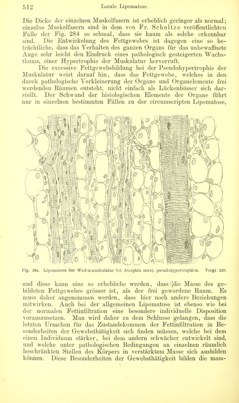 Die Dicke der einzelnen Muskelfasern ist erheblich geringer als normal; einzelne Muskelfasern sind in dem von Fr. Schultze veröffentlichten Falle der Fig. 284 so schmal, dass sie kaum als solche erkennbar sind. Die Entwickelung des Fettgewebes ist dagegen eine so be- trächtliche, dass das Verhalten des ganzen Organs für das unbewaffnete Auge sehr leicht den Eindruck eines pathologisch gesteigerten Wachs- thums, einer Hypertrophie der Muskulatur hervorruft. Die excessive Fettgewebsbildung bei der Pseudohypertrophie der Muskulatur weist darauf hin, dass das Fettgewebe, welches in den durch pathologische Verkleinerung der Organe und Organelemente frei werdenden Räumen entsteht, nicht einfach als Lückenbüsser sich dar- stellt. Der Schwund der histologischen Elemente der Organe führt nur in einzelnen bestimmten Fällen zu der circumscripten Lipomatose, Fig. 284. Lipomatose der Wadenmuskulatur bei Atropliia musc. pseudohypertrophica. Vergr. 220. und diese kann eine so erhebliche werden, dassijdie Masse des ge- bildeten Fettgewebes grösser ist, als der frei gewordene Raum. Es muss daher angenommen werden, dass hier noch andere Beziehungen mitwirken. Auch bei der allgemeinen Lipomatose ist ebenso wie bei der normalen Fettinfiltration eine besondere individuelle Disposition vorauszusetzen. Man wird daher zu dem Schlüsse gelangen, dass die letzten Ursachen für das Zustandekommen der Fettinfiltration in Be- sonderheiten der Grewebsthätigkeit sich finden müssen, welche bei dem einen Individuum stärker, bei dem andern schwächer entwickelt sind, und welche unter pathologischen Bedingungen an einzelnen räumlich beschränkten Stellen des Körpers in verstärktem Masse sich ausbilden können. Diese Besonderheiten der Grewebsthätigkeit bilden die mass-