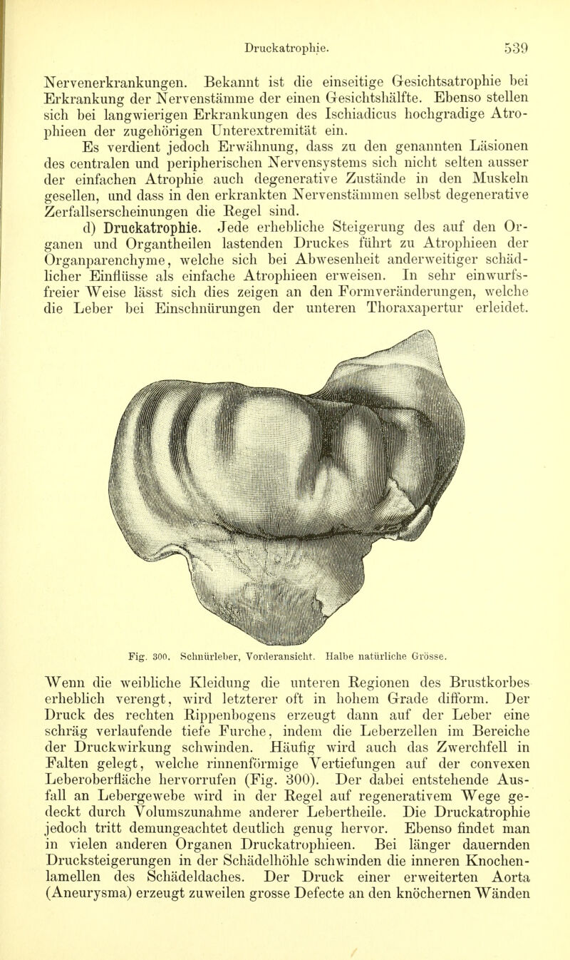 Nervenerkrankungen. Bekannt ist die einseitige Gesichtsatrophie hei Erkrankung der Nervenstämme der einen Gesichtshälfte. Ebenso stellen sich hei langwierigen Erkrankungen des Ischiadicus hochgradige Atro- phieen der zugehörigen Unterextremität ein. Es verdient jedoch Erwähnung, dass zu den genannten Läsionen des centralen und peripherischen Nervensystems sich nicht selten ausser der einfachen Atrophie auch degenerative Zustände in den Muskeln gesellen, und dass in den erkrankten Nervenstämmen seihst degenerative Zerfallserscheinungen die Regel sind. d) Druckatrophie. Jede erhebliche Steigerung des auf den Or- ganen und Organtheilen lastenden Druckes führt zu Atrophieen der Organparenchyme, welche sich bei Abwesenheit anderweitiger schäd- licher Einflüsse als einfache Atrophieen erweisen. In sehr einwurfs- freier Weise lässt sich dies zeigen an den Formveränderungen, welche die Leber bei Einschnürungen der unteren Thoraxapertur erleidet. Wenn die weibliche Kleidung die unteren Regionen des Brustkorbes erheblich verengt, wird letzterer oft in hohem Grade difform. Der Druck des rechten Rippenbogens erzeugt dann auf der Leber eine schräg verlaufende tiefe Furche, indem die Leberzellen im Bereiche der Druckwirkung schwinden. Häufig wird auch das Zwerchfell in Falten gelegt, welche rinnenförmige Vertiefungen auf der convexen Leberoberfläche hervorrufen (Fig. 300). Der dabei entstehende Aus- fall an Lebergewebe wird in der Regel auf regenerativem Wege ge- deckt durch Volumszunahme anderer Lebertheile. Die Druckatrophie jedoch tritt demungeachtet deutlich genug hervor. Ebenso findet man in vielen anderen Organen Druckatrophieen. Bei länger dauernden Drucksteigerungen in der Schädelhöhle schwinden die inneren Knochen- lamellen des Schädeldaches. Der Druck einer erweiterten Aorta (Aneurysma) erzeugt zuweilen grosse Defecte an den knöchernen Wänden Fig. 300. Schnürleber, Vorderansicht. Halbe natürliche Grösse,