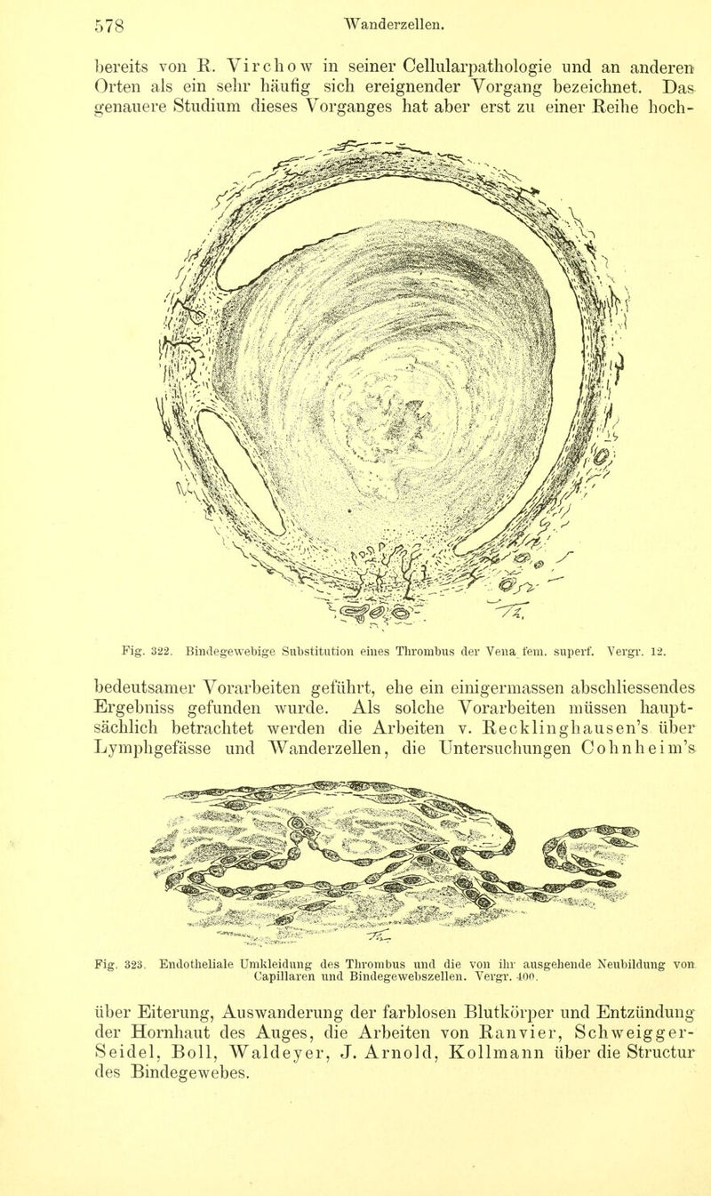 bereits von K. Vircliow in seiner Cellnlarpathologie und an anderen Orten als ein sehr häufig sich ereignender Vorgang bezeichnet. Das genauere Studium dieses Vorganges hat aber erst zu einer Reihe hoch- Fig. 322. Bindegewebige Substitution eines Thrombus der Vena fem. superf. Vergr. 12. bedeutsamer Vorarbeiten geführt, ehe ein einigermassen abschliessendes Ergebniss gefunden wurde. Als solche Vorarbeiten müssen haupt- sächlich betrachtet werden die Arbeiten v. Recklinghausen's über Lymphgefässe und Wanderzellen, die Untersuchungen Cohnheim's Fig. 323. Endotheliale Umkleidung des Thrombus und die von ihr ausgehende Neubildung von Capillaren und Bindegewebszellen. Vergr. 400. über Eiterung, Auswanderung der farblosen Blutkörper und Entzündung der Hornhaut des Auges, die Arbeiten von E an vier, Schweigg er- Seidel, Boll, Waldeyer, J.Arnold, Kollmann über die Structur des Bindegewebes.