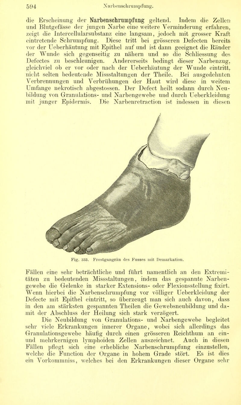 die Erscheinung der Narbenschrumpfung geltend. Indem die Zellen und Blutgefässe der jungen Narbe eine weitere Verminderung erfahren, zeigt die Intercellularsubstanz eine langsam, jedoch mit grosser Kraft eintretende Schrumpfung. Diese tritt bei grösseren Defecten bereits vor der Ueberhäutung mit Epithel auf und ist dann geeignet die Ränder der Wunde sich gegenseitig zu nähern und so die Schliessung des Defectes zu beschleunigen. Andererseits bedingt dieser Narbenzug. gleichviel ob er vor oder nach der Ueberhäutung der Wunde eintritt, nicht selten bedeutende Missstaltungen der Theile. Bei ausgedehnten Verbrennungen und Verbrühungen der Haut wird diese in weitem Umfange nekrotisch abgestossen. Der Defect heilt sodann durch Neu- bildung von Granulations- und Narbengewebe und durch Ueberkleidung mit junger Epidermis. Die Narbenretraction ist indessen in diesen Fig. 333. Frostgangrän <les Fusses mit Demarkation. Fällen eine sehr beträchtliche und führt namentlich an den Extremi- täten zu bedeutenden Missstaltungen, indem das gespannte Narben- gewebe die Gelenke in starker Extensions- oder Flexionsstellung fixirt. Wenn hierbei die Narbenschrumpfung vor völliger Ueberkleidung der Defecte mit Epithel eintritt, so überzeugt man sich auch davon, dass in den am stärksten gespannten Theilen die Gewebsneubildung und da- mit der Abschluss der Heilung sich stark verzögert. Die Neubildung von Granulations- und Narbengewebe begleitet sehr viele Erkrankungen innerer Organe, wobei sich allerdings das Granulationsgewebe häufig durch einen grösseren Reichthum an ein- und mehrkernigen lymphoiden Zellen auszeichnet. Auch in diesen Fällen pflegt sich eine erhebliche Narbenschrumpfung einzustellen, welche die Function der Organe in hohem Grade stört. Es ist dies ein Vorkommniss, welches bei den Erkrankungen dieser Organe sehr