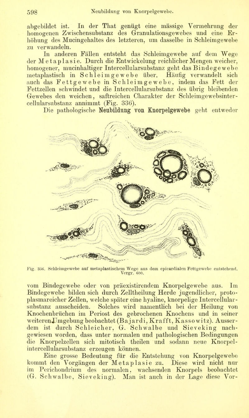 abgebildet ist. In der That genügt eine massige Vermehrung der homogenen Zwischensubstanz des Granulationsgewebes und eine Er- höhung des Mucingehaltes des letzteren, um dasselbe in Schleimgewebe zu verwandeln. In anderen Fällen entsteht das Schleimgewebe auf dem Wege der Metaplasie. Durch die Entwickelung reichlicher Mengen weicher, homogener, mucinhaltiger Intercellularsubstanz geht das Bindegewebe metaplastisch in Schleimgewebe über. Häufig verwandelt sich auch das Fettgewebe in Schleimgewebe, indem das Fett der Fettzellen schwindet und die Intercellularsubstanz des übrig bleibenden Gewebes den weichen, saftreichen Charakter der Schleimgewebsinter- cellularsubstanz annimmt (Fig. 336). Die pathologische Neubildung von Knorpelgewebe geht entweder Fig. 336. Schleimgewebe auf metaplastischem Wege aus dem epicardialen Fettgewebe entstehend. Vergr. 600. vom Bindegewebe oder von präexistirendem Knorpelgewebe aus. Im Bindegewebe bilden sich durch Zelltheilung Herde jugendlicher, proto- plasmareicher Zellen, welche später eine hyaline, knorpelige Intercellular- substanz ausscheiden. Solches wird namentlich bei der Heilung von Knochenbrüchen im Periost des gebrochenen Knochens und in seiner weiterenJJmgebungbeobachtet (Bajardi, Krafft, Kassowitz). Ausser- dem ist durch Schleicher, G. Schwalbe und Sieveking nach- gewiesen worden, dass unter normalen und pathologischen Bedingungen die Knorpelzellen sich mitotisch theilen und sodann neue Knorpel- intercellularsubstanz erzeugen können. Eine grosse Bedeutung für die Entstehung von Knorpelgewebe kommt den Vorgängen der Metaplasie zu. Diese wird nicht nur im Perichondrium des normalen, wachsenden Knorpels beobachtet (G. Schwalbe, Sieveking). Man ist auch in der Lage diese Vor-