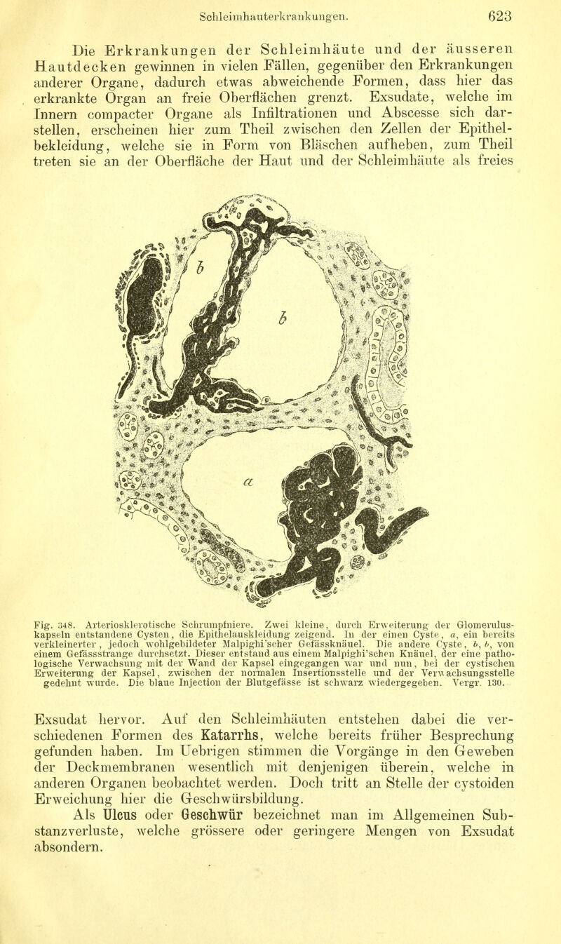 Die Erkrankungen der Schleimhäute und der äusseren Hautdecken gewinnen in vielen Fällen, gegenüber den Erkrankungen anderer Organe, dadurch etwas abweichende Formen, dass hier das erkrankte Organ an freie Oberflächen grenzt. Exsudate, welche im Innern compacter Organe als Infiltrationen und Abscesse sich dar- stellen, erscheinen hier zum Theil zwischen den Zellen der Epithel- bekleidung, welche sie in Form von Bläschen aufheben, zum Theil treten sie an der Oberfläche der Haut und der Schleimhäute als freies Fig. o48. Arteriosklerotische Schrumpfniere. Zwei kleine, durch Erweiterung der Glomerulus- kapseln entstandene Cysten, die Epithelauskleidung zeigend. In der einen Cyste, a, ein bereits verkleinerter, jedoch w^ohlgebildeter Malpighi'scher Gefässknäuel. Die andere Cyste, b, />, von einem Gefassstrange durchsetzt. Dieser entstand aus einem Malpighi'schen Knäuel, der eine patho- logische Verwachsung mit der Wand der Kapsel eingegangen war und nun, hei der cystischen Erweiterung der Kapsel, zwischen der normalen Insertionsstelle und der Vervachsungssteile gedehnt wurde. Die blaue Injection der Blutgefässe ist schwarz wiedergegeben. Vergr. 130. Exsudat hervor. Auf den Schleimhäuten entstehen dabei die ver- schiedenen Formen des Katarrhs, welche bereits früher Besprechung gefunden haben. Im Uebrigen stimmen die Vorgänge in den Geweben der Deckmembranen wesentlich mit denjenigen überein, welche in anderen Organen beobachtet werden. Doch tritt an Stelle der cystoiden Erweichung hier die Geschwürsbildung. Als Ulcus oder Geschwür bezeichnet man im Allgemeinen Sub- stanzverluste, welche grössere oder geringere Mengen von Exsudat absondern.