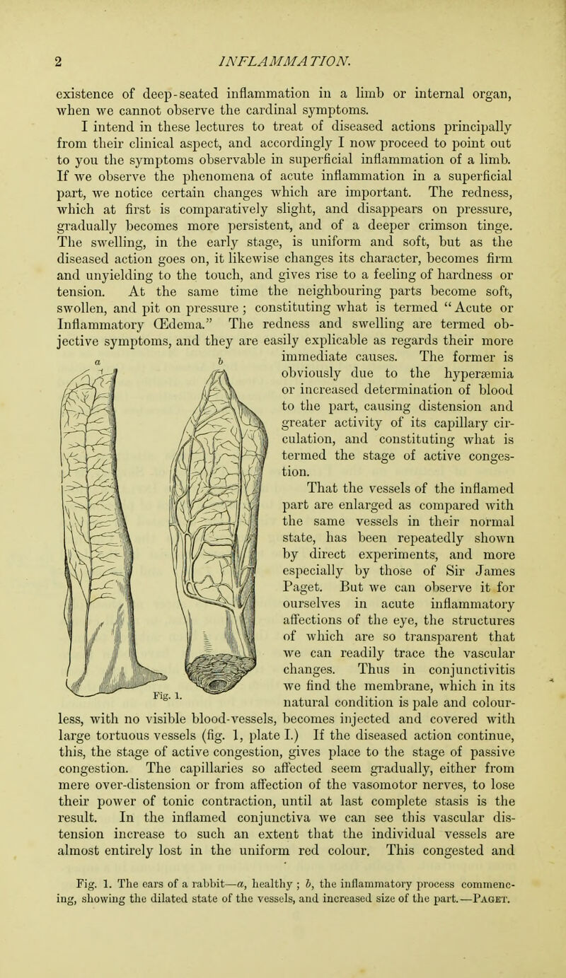 existence of deep-seated inflammation in a limb or internal organ, when we cannot observe the cardinal symptoms. I intend in these lectures to treat of diseased actions principally from their clinical aspect, and accordingly I now proceed to point out to you the symptoms observable in superficial inflammation of a limb. If we observe the phenomena of acute inflammation in a superficial part, we notice certain changes which are important. The redness, which at first is comparatively slight, and disappears on pressure, gradually becomes more persistent, and of a deeper crimson tinge. The swelling, in the early stage, is uniform and soft, but as the diseased action goes on, it likewise changes its character, becomes firm and unyielding to the touch, and gives rise to a feeling of hardness or tension. At the same time the neighbouring parts become soft, swollen, and pit on pressure ; constituting what is termed  Acute or Inflammatory (Edema. The redness and swelling are termed ob- jective symptoms, and they are easily explicable as regards their more immediate causes. The former is obviously due to the hyperemia or increased determination of blood to the part, causing distension and greater activity of its capillary cir- culation, and constituting what is termed the stage of active conges- tion. That the vessels of the inflamed part are enlarged as compared with the same vessels in their normal state, has been repeatedly shown by direct experiments, and more especially by those of Sir James Paget. But we can observe it for ourselves in acute inflammatory affections of the eye, the structures of which are so transparent that we can readily trace the vascular changes. Thus in conjunctivitis we find the membrane, which in its natural condition is pale and colour- less, with no visible blood-vessels, becomes injected and covered with large tortuous vessels (fig. 1, plate I.) If the diseased action continue, this, the stage of active congestion, gives place to the stage of passive congestion. The capillaries so affected seem gradually, either from mere over-distension or from affection of the vasomotor nerves, to lose their power of tonic contraction, until at last complete stasis is the result. In the inflamed conjunctiva we can see this vascular dis- tension increase to such an extent that the individual vessels are almost entirely lost in the uniform red colour. This congested and Fig. 1. The ears of a rabbit—a, healthy ; h, the inflammatory process commenc- ing, showing the dilated state of the vessels, and increased size of the part. —Paget.