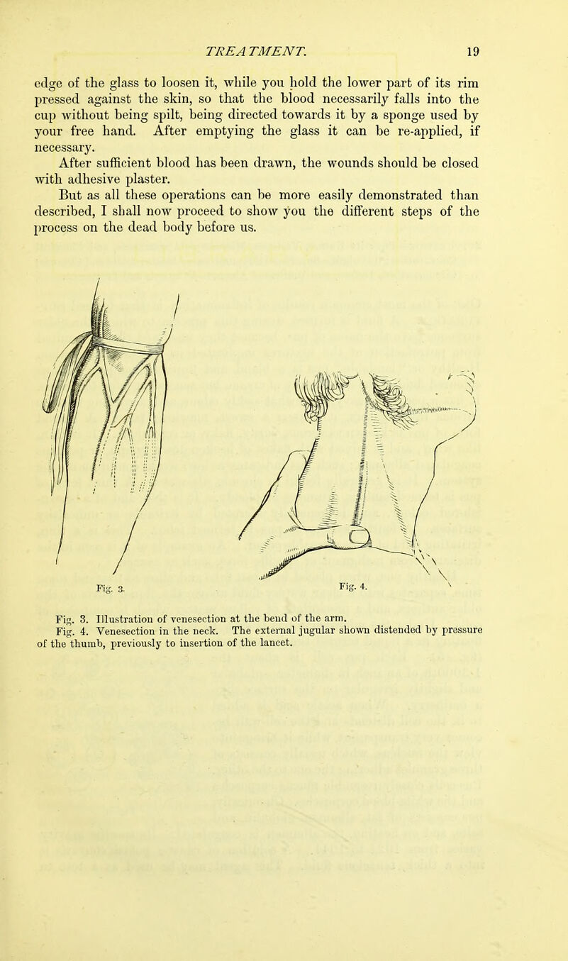 edge of the glass to loosen it, while you hold the lower part of its rim pressed against the skin, so that the blood necessarily falls into the cup without being spilt, being directed towards it by a sponge used by your free hand. After emptying the glass it can be re-applied, if necessary. After sufficient blood has been drawn, the wounds should be closed with adhesive plaster. But as all these operations can be more easily demonstrated than described, I shall now proceed to show you the different steps of the process on the dead body before us. Fig. 3. Illustration of venesection at the bend of the arm. Fig. 4. Venesection in the neck. The external jugular shown distended by pressure of the thumb, previously to insertion of the lancet.