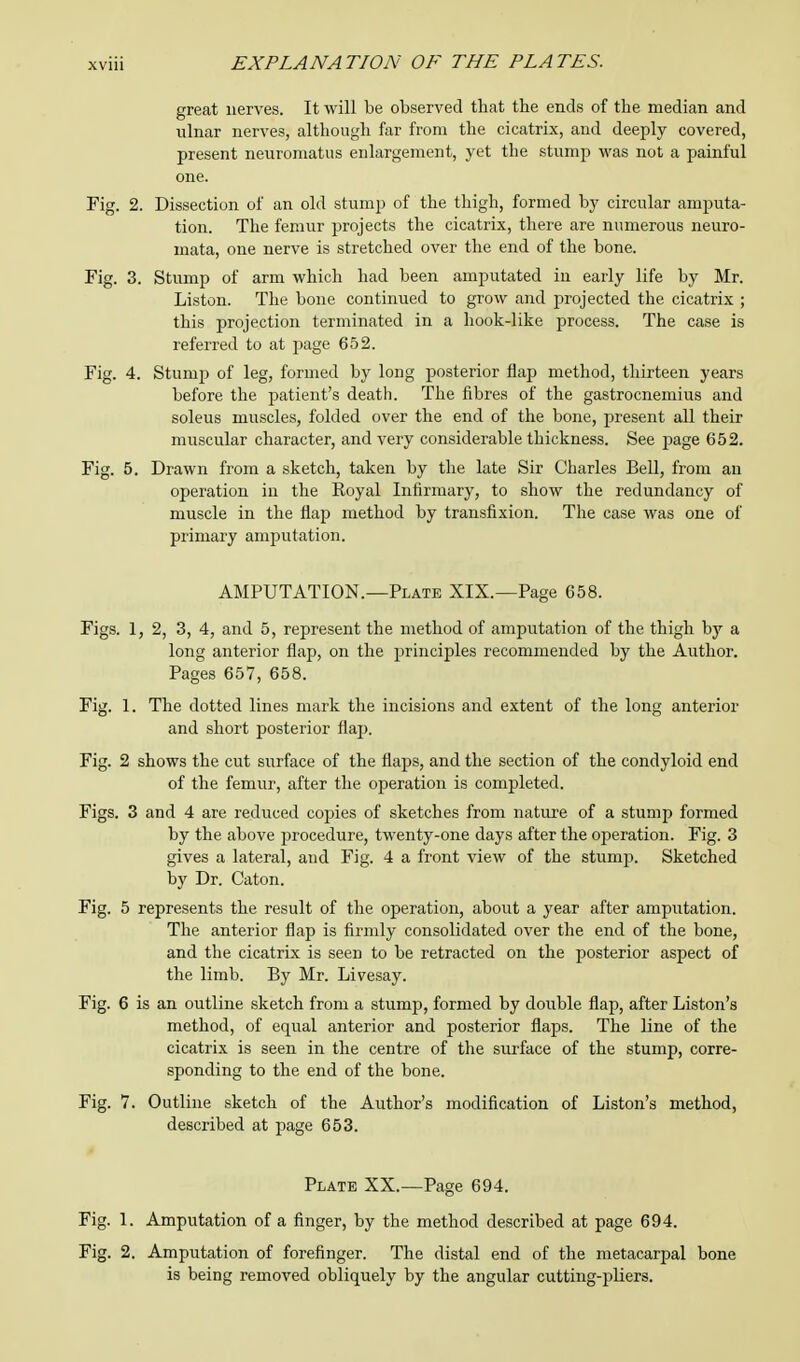 great nerves. It will be observed that the ends of the median and ulnar nerves, although far from the cicatrix, and deeply covered, present neuromatus enlargement, yet the stump was not a painful one. Fig. 2. Dissection of an old stump of the thigh, formed by circular amputa- tion. The femur projects the cicatrix, there are numerous neuro- mata, one nerve is stretched over the end of the bone. Fig. 3. Stump of arm which had been amputated iu early life by Mr. Liston. The bone continued to grow and projected the cicatrix ; this projection terminated in a hook-like process. The case is referred to at page 652. Fig. 4. Stump of leg, formed by long posterior flap method, thirteen years before the patient's death. The fibres of the gastrocnemius and soleus muscles, folded over the end of the bone, present all their muscular character, and very considerable thickness. See j)age 652. Fig. 5. Drawn from a sketch, taken by the late Sir Charles Bell, from an operation in the Royal Infirmary, to show the redundancy of muscle in the flap method by transfixion. The case was one of primary amputation. AMPUTATION.—Plate XIX.—Page 658. Figs. 1, 2, 3, 4, and 5, represent the method of amputation of the thigh by a long anterior flap, on the principles recommended by the Author. Pages 657, 658. Fig. 1. The dotted lines mark the incisions and extent of the long anterior and short posterior flap. Fig. 2 shows the cut surface of the flaps, and the section of the condyloid end of the femur, after the operation is completed. Figs. 3 and 4 are reduced copies of sketches from nature of a stump formed by the above procedure, twenty-one days after the operation. Fig. 3 gives a lateral, and Fig. 4 a front view of the stump. Sketched by Dr. Caton. Fig. 5 represents the result of the operation, about a year after amputation. The anterior flap is firmly consolidated over the end of the bone, and the cicatrix is seen to be retracted on the posterior aspect of the limb. By Mr. Livesay. Fig. 6 is an outline sketch from a stump, formed by double flap, after Liston's method, of equal anterior and posterior flaps. The line of the cicatrix is seen in the centre of the surface of the stump, corre- sponding to the end of the bone. Fig. 7. Outline sketch of the Author's modification of Liston's method, described at page 653. Plate XX.—Page 694. Fig. 1. Amputation of a finger, by the method described at page 694. Fig. 2. Amputation of forefinger. The distal end of the metacarpal bone is being removed obliquely by the angular cutting-pliers.