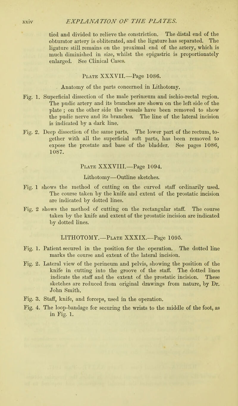 tied and divided to relieve the constriction. The distal end of the obturator artery is obliterated, and the ligature has separated. The ligature still remains on the proximal end of the artery, which is much diminished in size, whilst the epigastric is proportionately enlarged. See Clinical Cases. Plate XXXVII.—Page 1086. Anatomy of the parts concerned in Lithotomy. Fig. 1. Superficial dissection of the male perinteum and ischio-rectal region. The pudic artery and its branches are shown on the left side of the plate ; on the other side the vessels have been removed to show the pudic nerve and its branches. The line of the lateral incision is indicated by a dark line. Fig. 2. Deep dissection of the same parts. The lower part of the rectum, to- gether with all the superficial soft parts, has been removed to expose the prostate and base of the bladder. See pages 1086, 1087. Plate XXXVIIL—Page 1094. Lithotomy—Outline sketches. Fig. 1 shows the method of cutting on the curved staff ordinarily used. The course taken by the knife and extent of the prostatic incision are indicated by dotted lines. Fig. 2 shows the method of cutting on the rectangular staff. The course taken by the knife and extent of the prostatic incision are indicated by dotted lines. LITHOTOMY.—Plate XXXIX.—Page 1095. Fig. 1. Patient secured in the position for the operation. The dotted line marks the course and extent of the lateral incision. Fig. 2. Lateral view of the perineum and pelvis, showing the position of the knife in cutting into the groove of the staff. The dotted lines indicate the staff and the extent of the prostatic incision. These sketches are reduced from original drawings from nature, by Dr. John Smith. Fig. 3. Staff, knife, and forceps, used in the operation. Fig. 4. The loop-bandage for securing the wrists to the middle of the foot, as in Fig. 1.