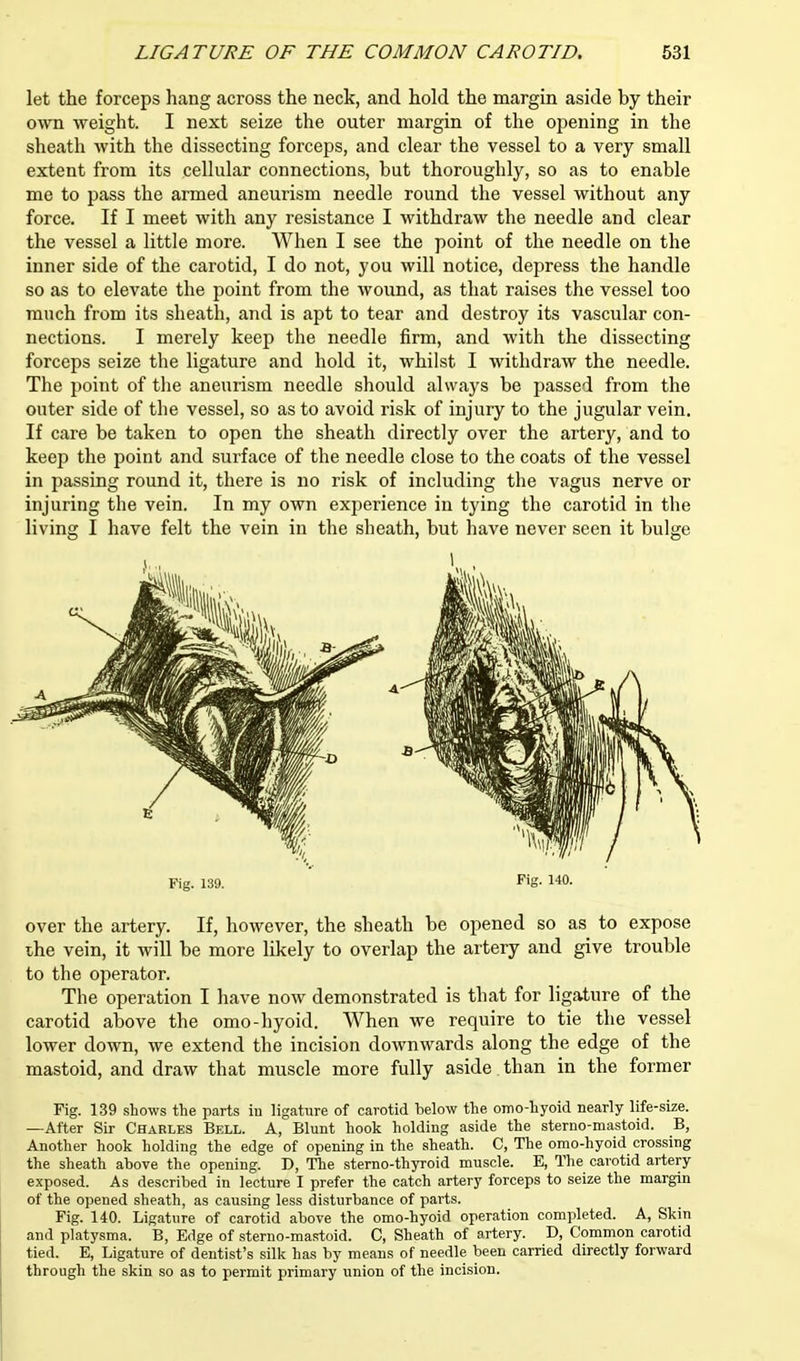 let the forceps hang across the neck, and hold the margin aside by their own weight. I next seize the outer margin of the opening in the sheath with the dissecting forceps, and clear the vessel to a very small extent from its cellular connections, but thoroughly, so as to enable me to pass the armed aneurism needle round the vessel without any force. If I meet with any resistance I withdraw the needle and clear the vessel a little more. When I see the point of the needle on the inner side of the carotid, I do not, you will notice, depress the handle so as to elevate the point from the wound, as that raises the vessel too much from its sheath, and is apt to tear and destroy its vascular con- nections. I merely keep the needle firm, and with the dissecting forceps seize the ligature and hold it, whilst I withdraw the needle. The point of the aneurism needle should always be passed from the outer side of the vessel, so as to avoid risk of injury to the jugular vein. If care be taken to open the sheath directly over the artery, and to keep the point and surface of the needle close to the coats of the vessel in passing round it, there is no risk of including the vagus nerve or injuring the vein. In my own experience in tying the carotid in the living I have felt the vein in the sheath, but have never seen it bulge Fig. 139. Fig- 140. over the artery. If, however, the sheath be opened so as to expose the vein, it will be more likely to overlap the artery and give trouble to the operator. The operation I have now demonstrated is that for ligature of the carotid above the omo-hyoid. When we require to tie the vessel lower down, we extend the incision downwards along the edge of the mastoid, and draw that muscle more fully aside. than in the former Fig. 139 shows the parts in ligature of carotid below the omo-hyoid nearly life-size. —After Sir Charles Bell. A, Blunt hook holding aside the sterno-mastoid. B, Another hook holding the edge of opening in the sheath. C, The omo-hyoid crossing the sheath above the opening. D, The sterno-thyroid muscle. E, The carotid artery exposed. As described in lecture I prefer the catch artery forceps to seize the margin of the opened sheath, as causing less disturbance of parts. Fig. 140. Ligature of carotid above the omo-hyoid operation completed. A, Skin and platysma. B, Edge of sterno-mastoid. C, Sheath of artery. D, Common carotid tied. E, Ligature of dentist's silk has by means of needle been carried directly forward through the skin so as to permit primary union of the incision.