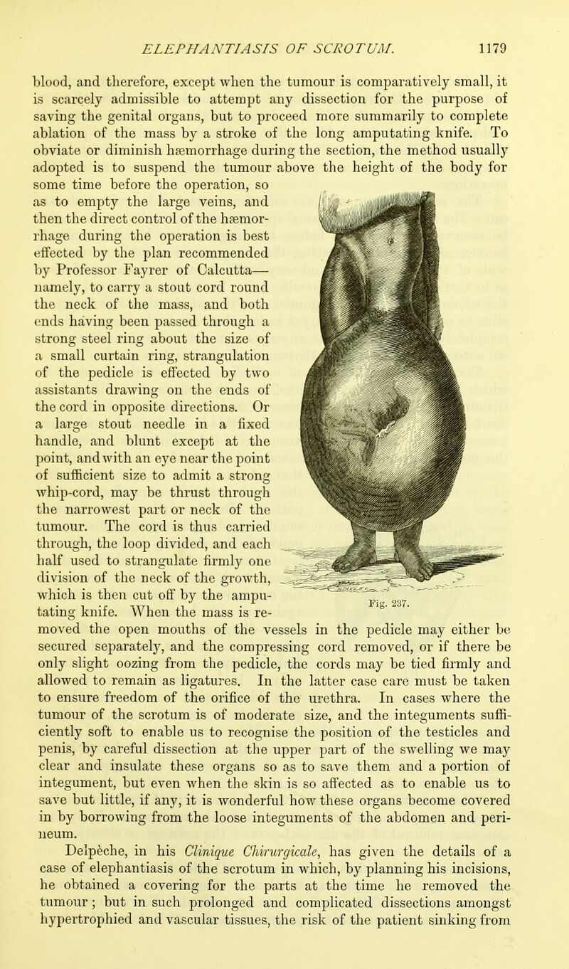 blood, and therefore, except when the tumour is comparatively small, it is scarcely admissible to attempt any dissection for the purpose of saving the genital organs, but to proceed more summarily to complete ablation of the mass by a stroke of the long amputating knife. To obviate or diminish hemorrhage during the section, the method usually adopted is to suspend the tumour above the height of the body for some time before the operation, so as to empty the large veins, and then the direct control of the haemor- rhage during the operation is best effected by the plan recommended by Professor Fayrer of Calcutta— namely, to carry a stout cord round the neck of the mass, and both ends having been passed through a strong steel ring about the size of a small curtain ring, strangulation of the pedicle is effected by two assistants drawing on the ends of the cord in opposite directions. Or a large stout needle in a fixed handle, and blunt except at the point, and with an eye near the point of sufficient size to admit a strong whip-cord, may be thrust through the narrowest part or neck of the tumour. The cord is thus carried through, the loop divided, and each half used to strangulate firmly one division of the neck of the growth, which is then cut off by the ampu- tating knife. When the mass is re- moved the open mouths of the vessels in the pedicle may either be secured separately, and the compressing cord removed, or if there be only slight oozing from the pedicle, the cords may be tied firmly and allowed to remain as ligatures. In the latter case care must be taken to ensure freedom of the orifice of the urethra. In cases where the tumour of the scrotum is of moderate size, and the integuments suffi- ciently soft to enable us to recognise the position of the testicles and penis, by careful dissection at the upper part of the swelling we may clear and insulate these organs so as to save them and a portion of integument, but even when the skin is so affected as to enable us to save but little, if any, it is wonderful how these organs become covered in by borrowing from the loose integuments of the abdomen and peri- neum. Delpeche, in his Clinique Chirurgicale, has given the details of a case of elephantiasis of the scrotum in which, by planning his incisions, he obtained a covering for the parts at the time he removed the tumour; but in such prolonged and complicated dissections amongst hypertrophied and vascular tissues, the risk of the patient sinking from Fig. 237.