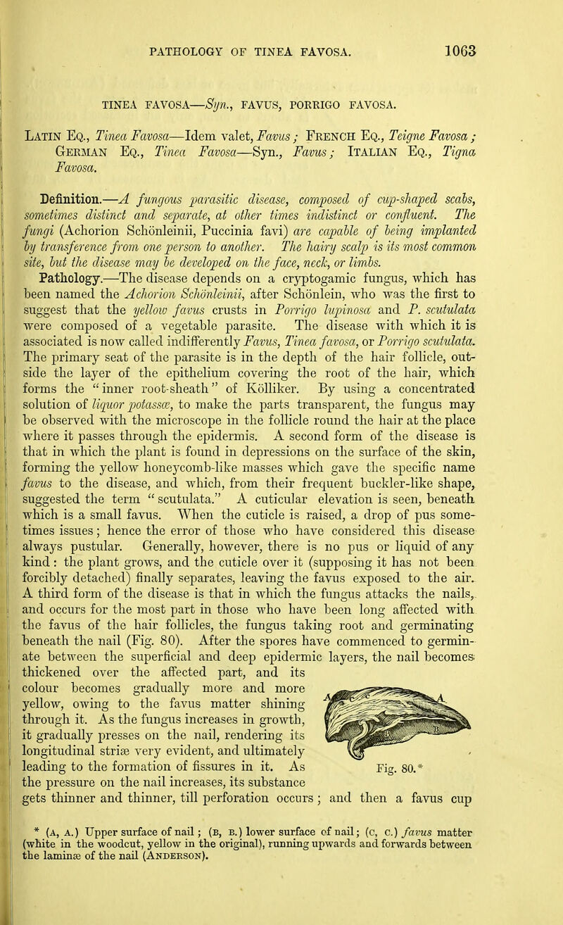 TINEA FAVOSA—Syn., FAVUS, PORRIGO FAVOSA. Latin Eq., Tinea Favosa—Idem \dlQi,Favus ; French Eq., Teigne Favosa ; German Eq., Tinea Favosa—Syn., Favus; Italian Eq., Tigna Favosa. Definition.—A fungous parasitic disease, composed of cup-shaped scabs, sometimes distinct and separate, at other times indistinct or confluent. The fungi (Achorion Schonleinii, Puccinia favi) are capable of being implanted by transference from one person to another. The hairy scalp is its most common site, but the disease may be developed on the face, nccJc, or lim,bs. Pathology.—The disease depends on a cryptogamic fungus, which has been named tlie Achorion Schonleinii, after Schonlein, who was the first to suggest that the yelloio favus crusts in Porrigo hpinosa and P. scutulata were composed of a vegetable parasite. The disease with which it is associated is now called indifferently Favus, Tinea favosa, or Porrigo scutidata. The primary seat of the parasite is in the depth of the hair follicle, out- side the layer of the epithelium covering the root of the hair, which forms the inner root-sheath of Kolliker. By using a concentrated solution of liciuor potasso}, to make the parts transparent, the fungus may be observed with the microscope in the follicle round the hair at the place where it passes through the epidermis. A second form of the disease is that in which the plant is found in depressions on the surface of the skin, forming the yellow honeycomb-like masses which gave the specific name favus to the disease, and which, from their frequent buckler-like shape, suggested the term  scutulata. A cuticular elevation is seen, beneath i which is a small favus. When the cuticle is raised, a drop of pus some- times issues; hence the error of those who have considered this disease always pustular. Generally, however, there is no pus or liquid of any kind: the plant grows, and the cuticle over it (supposing it has not been ]j forcibly detached) finally separates, leaving the favus exposed to the air. [! A third form of the disease is that in which the fungus attacks the nails, and occurs for the most part in those who have been long affected with the favus of the hair follicles, the fungus taking root and germinating beneath the nail (Fig. 80). After the spores have commenced to germin- ate between the superficial and deep epidermic layers, the nail becomes thickened over the affected part, and its j colour becomes gradually more and more yellow, owing to the favus matter shining I through it. As the fungus increases in growth, it gradually presses on the nail, rendering its longitudinal striae very evident, and ultimately I leading to the formation of fissures in it. As Fig. 80.* the pressure on the nail increases, its substance gets thinner and thinner, till perforation occurs ; and then a favus cup * (a, a.) Upper surface of nail; (b, b.) lower surface cf nail; (c, c.) favus matter (white in the woodcut, yellow in the original), running upwards and forwards between the laminse of the nail (Anderson).
