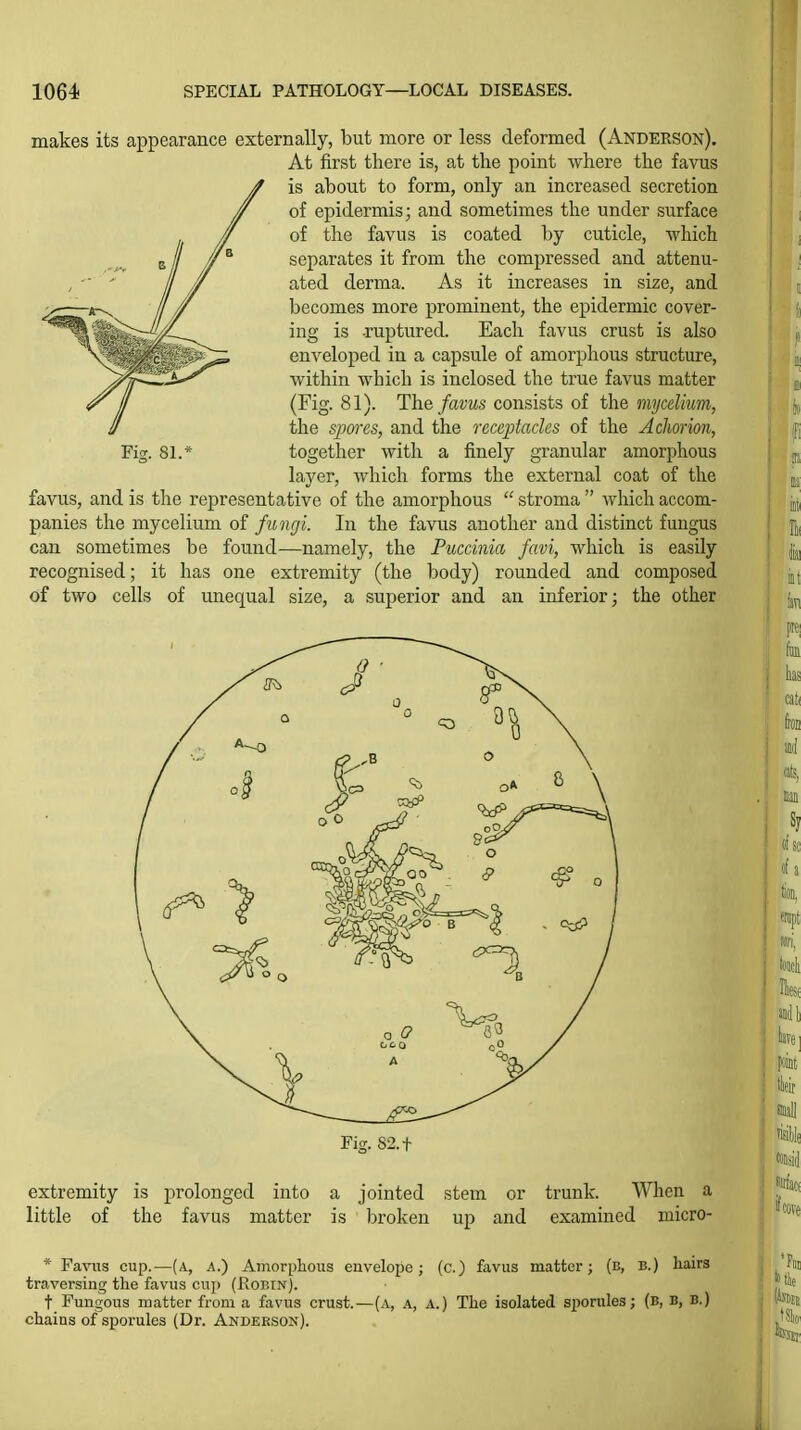 makes its appearance externally, but more or less deformed (Anderson). At first there is, at the point where the favus is about to form, only an increased secretion of epidermis; and sometimes the under surface of the favus is coated by cuticle, which separates it from the compressed and attenu- ated derma. As it increases in size, and becomes more prominent, the epidermic cover- ing is -ruptured. Each favus crust is also enveloped in a capsule of amorphous structure, within which is inclosed the true favus matter (Fig. 81). The favus consists of the mycelium, the spores, and the receptacles of the A chorion, together with a finely granular amorphous layer, which forms the external coat of the favus, and is the representative of the amorphous  stroma  which accom- panies the mycelium of fungi. In the favus another and distinct fungus can sometimes be found—namely, the Puccinia favi, which is easily recognised; it has one extremity (the body) rounded and composed of two cells of unequal size, a superior and an inferior; the other Ficr. 81. Fig. 82. t extremity is prolonged into little of the favus matter jointed stem or broken up and trunk. When a examined uiicro- * Favus cup.—(a, a.) Amorphous envelope; (c.) favus matter; (b, b.) liairs traversing the favus cup (Bobin). t Fungous matter from a favus crust.—(a, a, a.) The isolated siwrules; (B, B, B.) chains of sporules (Dr. Anderson).