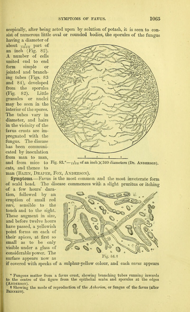 scopically, after being acted upon by solution of potash, it is seen to con- sist of numerous little oval or rounded bodies, the sporules of the fungus having a diameter of about yyV(7 part of an inch (Fig. 82). A number of cells united end to end form simple or jointed and branch- ing tubes (Figs. 83 and 84), developed from the sporules (Fig. 82). Little granules or nuclei may be seen in the interior of the spores. The tubes vary in diameter, and hairs in the vicinity of the favus crusts are im- pregnated with the fungus. The disease has been communi- cated by inoculation from man to man, and from mice to K, cats, and thence to man (Bazin, Draper, Fox, Anderson). Symptoms.—Favus is the most common and the most inveterate form of scald head. The disease commences witi a slight pruritus or itching of a few hours' dura- of an inch X 340 diameters (Dr. Andeeson). tion, followed by eruption of small an red sensible to the touch and to the sight. These augment in size, and before twelve hours have passed, a yellowish point forms on each of their apices, at first so small as to be only visible under a glass of considerable power. The surface appears now as if covered with specks of a sulphur-yellow colour, and each varus appears Fisr. 84.t * Fungous matter from a favus crust, showing branching tubes running inwards to the centre of the figure from the epithelial scabs and sporules at the edges (Anderson). t Showing the mode of reproduction of the A chorion, or fungus of the favus (after Bennett).