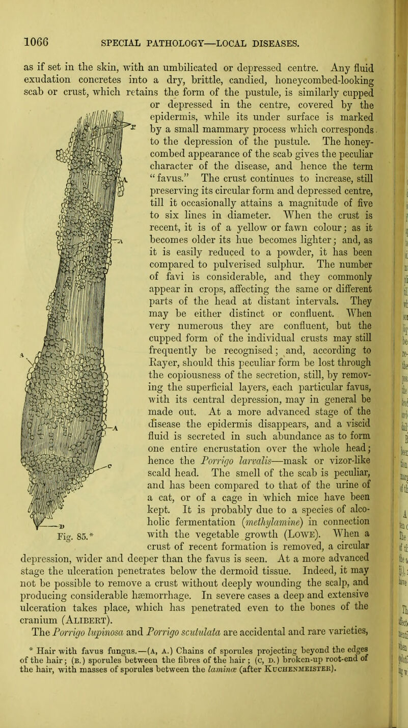 as if set in the skin, with, an umbilicated or depressed centre. Any fluid exudation concretes into a dry, brittle, candied, lioneycombed-looking scab or crust, which retains the form of the pustule, is similarly cupped or depressed in the centre, covered by the epidermis, while its under surface is marked by a small mammary process which corresponds. to the depression of the pustule. The honey- combed appearance of the scab gives the peculiar character of the disease, and hence the term  favus. The crust continues to increase, still preserving its circular form and depressed centre, till it occasionally attains a magnitude of five to six lines in diameter. AVhen the crust is recent, it is of a yellow or fawn colour; as it becomes older its hue becomes lighter; and, as it is easily reduced to a powder, it has been compared to pulverised sulphur. The number of favi is considerable, and they commonly appear in crops, affecting the same or different parts of the head at distant intervals. They may be either distinct or confluent. When very numerous they are confluent, but the cupped form of the individual crusts may still frequently be recognised; and, according to Eayer, should this peculiar form be lost through J^-^^'^W^^Im^aU ^^^^ copiousness of the secretion, still, by remov- ing the superficial layers, each particular favus, with its central depression, may in general be made out. At a more advanced stage of the disease the epidermis disappears, and a viscid fluid is secreted in such abundance as to form one entire encrustation over the whole head; hence the Porrigo larvalis—mask or vizor-Hke scald head. The smell of the scab is peculiar, and has been compared to that of the urine of a cat, or of a cage in which mice have been kept. It is probably due to a species of alco- holic fermentation (methylamine) in connection with the vegetable growth (Lowe). When a crust of recent formation is removed, a circular depression, wider and deeper than the favus is seen. At a more advanced stage the ulceration penetrates below the dermoid tissue. Indeed, it may not be possible to remove a crust without deeply wounding the scalp, and producing considerable haemorrhage. In severe cases a deep and extensive ulceration takes place, which has penetrated even to the bones of the cranium (Alibbrt). The Porrigo lupinosa and Porrigo sadulata are accidental and rare varieties, Tier. 85. * Hair with favus fungus.—(a, a.) Chains of sporules projecting beyond the edges of the hair; (b. ) sporules between the fibres of the hair ; (c, d.) broken-up root-end of the hair, with masses of sporules between the lamince (after Kuchenmeistek).