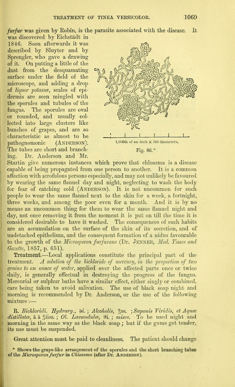 furfur was given by Eobin, is the parasite associated with the disease. It was discovered by Eichstadt in 1846. Soon afterwards it was described by Shiyter and by Sprengler, who gave a drawing of it. On putting a little of the dust from the desquamating surface under the field of the microscope, and adding a drop of lufim potassce, scales of epi- dermis are seen mingled with I the sporules and tubules of the i fungus. The sporules are oval j or rounded, and usually col- j lected into large clusters like bunches of grapes, and are so characteristic as almost to be pathognomonic (Anderson). '■'^ '^^ x diameters. The tubes are short and branch- Fig. 86.* ing. Dr. Anderson and Mr. Startin give numerous instances which prove that chloasma is a disease capable of being propagated from one person to another. It is a common affection with scrofulous persons especially, and may not unlikely be favoured by wearing the same flannel day and night, neglecting to wash the body for fear of catching cold (Anderson). It is not uncommon for such people to wear the same flannel next to the skin for a week, a fortnight, three weeks, and among the poor even for a month. And it is by no means an uncommon thing for them to wear the same flannel night and ; day, not once removing it from the moment it is put on till the time it is considered desirable to have it washed. The consequences of such habits are an accumulation on the surface of the bkin of its secretion, and of undetached epithelium, and the consequent formation of a nidus favourable to the growth of the Microsporon fiirfurans (Dr. Jenner, Med. Times and i' Gazette, 1857, p. 651). Treatment.—Local applications constitute the principal part of the treatment. A solution of the hicMonde of mercury, in the proportion of two grains to an ounce of wcder, applied over the affected parts once or twice daily, is generally effectual in destroying the progress of the fungus. Mercurial or sulphur baths have a similar effect, either singly or combined, care being taken to avoid salivation. The use of black soap night and morning is recommended by Dr. Anderson, or the use of the following mixture:— R. BicMoridi. Hydrarg., Bi. ; AlcoJiolis, gss. ; Saponis Viridis, et Aquce distillatce, a a giiss.; 01. Lavandulae., 91. ; misce. To be used night and morning in the same way as the black soap ; but if the gums get tender, its use must be suspended. Great attention must be paid to cleanliness. The patient should change * Shows the grape-like arrangement of the sporules and the short branching tubes of the Microsporon furfur in Chloasma (after Dr. Anderson).