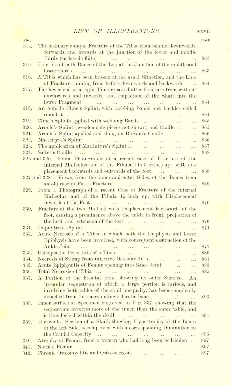 FIG, PAGE o 1 ±. Xiio oi'clinjiry odIk-Jug J-M'ficturc oi idg i.ibiM irom oGiiiDfi downwurus, forwcirds, tincl inwrirds ;tt tho ] unction ot tliG low(;*r ;iiid. iniddlf' thirds (gh boc dG fliitc] ... ... ... ... ... ... 863 315 H iio4'n>'0 /IT r~>rif n 1 .nnoc /it Trio 1 .oii q T 4n<i Tiinz-i'im'i 11+ f iio n^idillij qti(I lU W Ul LXi in l.> ... ... .,. ... ,,, ... ... ... S63 316 jfV liljiii whicli hfis Idggh brolsGn bX the usunl tSitu&tion, iiiid the Liiio of FrfictiirG Tunmrij^' from IjGfoi'G downvvjirds 3.iid btickwfirds ... 864 Pho lower 6nd of a right Tibiii rcps-ired aftGv l*^racturG from without downwiirds find inwurds, and Impjxction. of thy Shaft into tlio i.'-' W \_,L i_ L Xg illv^lll' ... ... ... ... ... ... ... 864 318. A_n outsido Cliiie's Splint, with wclibing bands und buoklGs Goilcd round it . . 864 319. ClinG s Splints applied with WGbbing Hands 865 Arnold's Splint (wooden skIg piccGS not shown] and Cradle... ... 321. Arnold's Splint applied and slung on Bloxam's Cradle 866 32l\ Maclntyre's S])lint «G6 323. The application of Maclntyre's Splint ... 867 324. Salter's Cradle 868 325 and 326. From Phutogruphs of a recent case of Fracture of the internal Malleolus and of the Fibula 2 to 3 inches up; with dis- placement backwards and outwards of thi'foot ... ... ... 868 327 and 328. Views, from the inner and outer .Sidc.-<, of the Bones from an old case of Pott's Fracture ... ... ... ... ... 869 329. From a Photograph of a recent Case of Fracture of tlie intern;il iMalleolus, and of the Fibula IJ inch up, with Displacement inwards of the Foot ... ... ... ... ... ... ... 870 330. Fracture of the two Malleoli with Displacement backwards of the foot, causing a prominence above the ankle in front, projection of the heel, and extension of the foot ... ... ... ... ... 870 331. Dupuytren's Splint 871 332. Acute Necrosis of a Tibia in which both tin; Diaphysis and lower Epijihysis have been involved, with consequent destruction of the Ankle Joint ... 877 333. Osteoplastic Perio.stitis of a Tibia ... 880 33'1. Necrosis of Stump from infective Osteomyelitis ... 881 335. Acute Epiphysitis of Femur opening into Knee Joint ... 883 336. Total Necrosis of Tibia ... ... 885 337. A Portion of the Frontal Bone showing its outer Surface. An incgular sequestrum of which a large portion is carious, and involving- both tables of the skull unequally, has been comjjletely detached from the surrounding sclerotic bono ... ... 893 338. Inner surface of Specimen engraved in Fig. 337, showing that the sequestrum involves more of the inner than the outer table, and is thus locked within the skull ... ... ... ... ... 894 339. Horizontal Section of a Skull, showing Hypertrophy of the Bones of the left Side, accompanied with a corresponding Diminution in the Cranial Capacity ... ... ... ... ... ... ... 896 340. Atrophy of Femur, fron a woman who had long been bedridden ... 897 341. Normal Femur 897 342. Chi-onic Osteomyelitis and Osteosclerosis ... ... ... ... 897