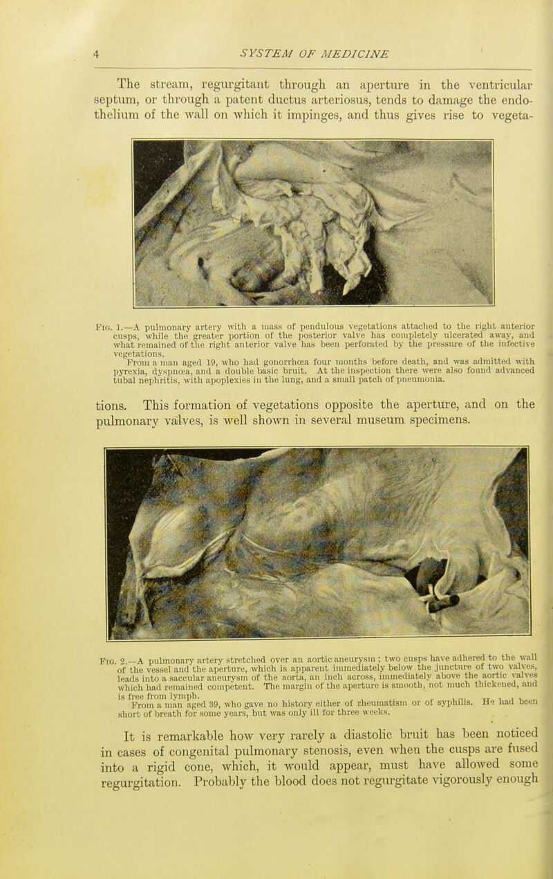 The stream, regurgitant through an aperture in the ventricular septum, or through a patent ductus arteriosus, tends to damage the endo- thelium of the wall on which it impinges, and thus gives rise to vegeta- FiG. 1.—A pulmonary artery with a mass of ])endulous vegetations attached to the right antejior cusps, wliile the greater portion of the posterior valve has completely ulcerated away, and what remained of the right anterior valve has been perforated by the pressure of the infective vegetations. From a man aged 19, who had gonorrhoea four mouths before death, and was admitted with pyrexia, dyspnoea, and a double basic bruit. At the inspection there were also found advanced tubal nephritis, with apoplexies in the lung, and a small patch of inieumonia. tions. This formation of vegetations opposite the aperture, and on the pulmonary valves, is well shown in several museum specimens. Fig 2 —A i)ulmonary artery stretched over an aortic aneurysm ; two cusps have adhered to the wall of the vessel and the aperture, which is apparent immediately below the juncture of two valves, leads into a saccular aneurysm of the aorta, an inch across, immediately above the aortic valves which had remained competent. The margin of the aperture is smooth, not much thickened, and is free from lymph. tj i j v From a man aged 39, who gave no history either of rheumatism or of syphilis. He had been short of breath for some years, but was only ill for three weeks. It is remarkable how very rarely a diastolic bruit has been noticed in cases of congenital pulmonary stenosis, even when the cusps are fused into a rigid cone, which, it would appear, must have allowed some regurgitation. Probably the blood does not regurgitate vigorously enough