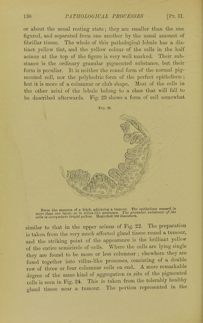 or about the usual resting state; they are smaller than the one figured, and separated from one another by the usual amount of fibrillar tissue. The whole of this pathological lobule has a dis- tinct yellow tint, and the yellow colour of the cells in the half acinus at the top of the figure is very well marked. Their sub- stance is the ordinary granular pigmented substance, but their form is peculiar. It is neither the round form of the normal pig- mented cell, nor the polyhedric form of the perfect epithelium; but it is more of a columnar or club shape. Most of the cells in the other acini of the lobule belong to a class that will fall to be described afterwards. Fig. 23 shows a form of cell somewhat Fig. 23. From the mamma of a bitch, adjoining a tumour. The epithehum massed m more than one layer, or in villus-like processes. The granular substance oj the cells is everywhere bright yellow. Magnified 300 diameters. similar to that in the upper acinus of Fig. 22. The preparation is taken from the very much affected gland tissue round a tumour, and the striking point of the appearance is the brilliant yellow of the entire semicircle of-cells. Where the cells are lying single they are found to be more or less columnar ; elsewhere they are fused together into villus-like processes, consisting of a double row of three or four columnar cells on end. A more remarkable degree of the same kind of aggregation in situ of the pigmented cells is seen in Fig. 24. This is taken from the tolerably healthy gland tissue near a tumour. The portion represented in the