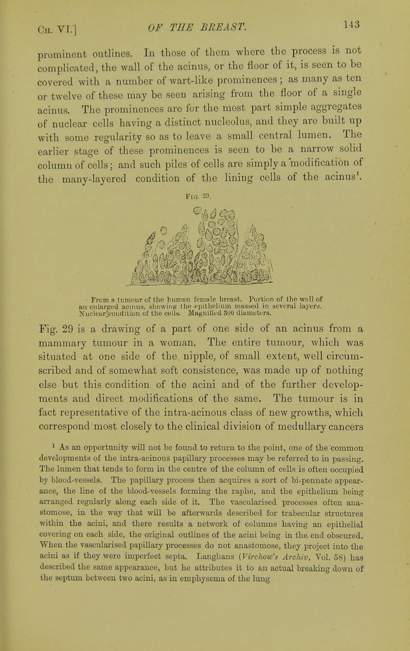 prominent outlines. In those of them where the process is not complicated, the wall of the acinus, or the floor of it, is seen to be covered with a number of wart-like prominences ; as many as ten or twelve of these may be seen arising from the floor of a single acinus. The prominences are for the most part simple aggregates of nuclear cells having a distinct nucleolus, and they are built up with some regularity so as to leave a small central lumen. The earlier stage of these prominences is seen to be a narrow solid column of cells; and such piles of cells are simply a modification of the many-layered condition of the lining cells of the acinus\ Fig. 29. ■ rrom a tumour of the human femjile breast. Portion of the wall of an enlarged acinus, showing ihe epithelium massed in several layers. Nuclearicondition of the cells. Magnified 3U0 d.iameters. Fig. 29 is a drawing of a part of one side of an acinus from a mammary tumour in a woman. The entire tumour, which was situated at one side of the. nipple, of small extent, well circum- scribed and of somewhat soft consistence, was made up of nothing else but this condition of the acini and of the further develop- ments and direct modifications of the same. The tumour is in fact representative of the intra-acinous class of new growths, which correspond most closely to the clinical division of medullary cancers ^ As an opportnnity will not be fonnd to retiu-n to the point, one of the common developments of the intra-acinous papillary processes may be referred to in passing. The lumen that tends to form in the centre of the column of cells is often occupied by blood-yessels. The papillary process then acquu-es a sort of bi-jDennate appear- ance, the line of the blood-vessels forming the rajohe, and the epithelium being arranged regularly along each side of it. The vascularised processes often ana- stomose, in the way that will be afterwards described for trabecular structm-es within the acini, and there results a network of columns having an epithelial covering on each side, the original outlines of the acini being in the end obscured. When the vascularised papillary processes do not anastomose, they project into the acini as if they were imperfect septa. Langhans (Virchoiv's Archiv, Vol. 58) has described the same appearance, but he attributes it to an actual breaking down of the septum between two acini, as in emphysema of the lung