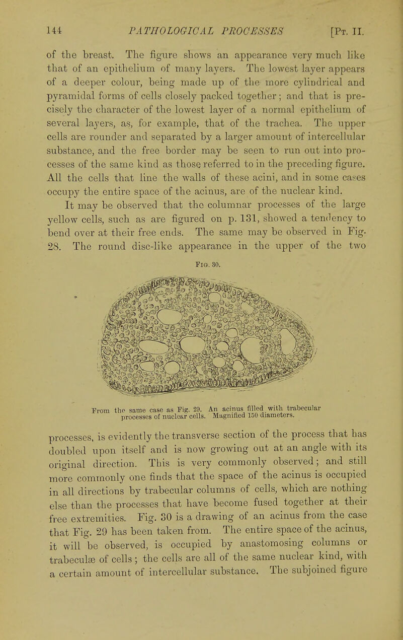 of the breast. The figure shows an appearance very much like that of an epithelium of many layers. The lowest layer appears of a deeper colour, being made up of the more cylindrical and pyramidal forms of cells closely packed together; and that is pre- cisely the character of the lowest layer of a normal epithelium of several layers, as, for example, that of the trachea. The upper cells are rounder and separated by a larger amouut of intercelhilar substance, and the free border may be seen to run out into pro- cesses of the same kind as those referred to in the preceding figure. All the cells that line the walls of these acini, and in some caj-:es occupy the entire space of the acinus, are of the nuclear kind. It may be observed that the columnar processes of the large yellow cells, such as are figured on p. 131, showed a tendency to bend over at their free ends. The same may be observed in Fig- 28. The round disc-like appearance in the upper of the two Fig. 30. Prom tho same case as Fig. 29. An acinus filled with trabecular processes of nucle&r cells. Magnifled 150 diameters. processes, is evidently the transverse section of the process that has doubled upon itself and is now growing out at an angle with its original direction. This is very commonly observed; and still more commonly one finds that the space of the acinus is occupied in all directions by trabecular columns of cells, which are nothing else than the processes that have become fused together at their free extremities. Fig. 30 is a drawing of an acinus from the case that Fig. 29 has been taken from. The entire space of the acinus, it will be observed, is occupied by anastomosing columns or trabeculse of cells ; the cells are all of the same nuclear kind, with a certain amount of intercellular substance. The subjoined figure