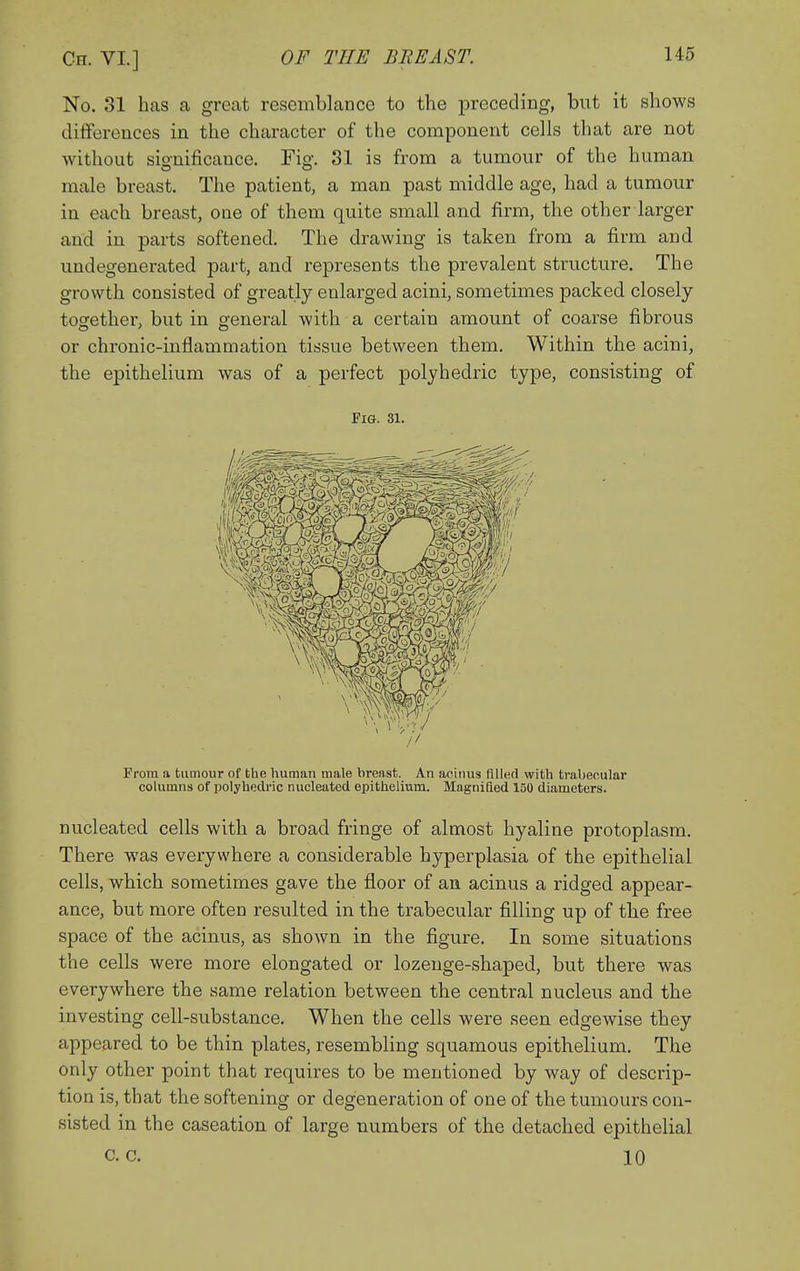 No. 31 has a great resemblance to the preceding, but it shows differences in the character of the component cells that are not without sionificauce. Fisr. 31 is from a tumour of the human o o male breast. The patient, a man past middle age, had a tumour in each breast, one of them quite small and firm, the other larger and in parts softened. The drawing is taken from a firm and uudegenerated part, and represents the prevalent structure. The growth consisted of greatly enlarged acini, sometimes packed closely- together, but in general with a certain amount of coarse fibrous or chronic-inflammation tissue between them. Within the acini, the epithelium was of a perfect polyhedric type, consisting of Fig. 31. Prom a tumour of the human male breast. An acinus filled with trabecular columns of polyhedi'ic nucleated epithelium. Magnified 150 diameters. nucleated cells with a broad fringe of almost hyaline protoplasm. There was everywhere a considerable hyperplasia of the epithelial cells, which sometimes gave the floor of an acinus a ridged appear- ance, but more often resulted in the trabecular filling up of the free space of the acinus, as shown in the figure. In some situations the cells were more elongated or lozeuge-shaped, but there was everywhere the same relation between the central nucleus and the investing cell-substance. When the cells were seen edgewise they appeared to be thin plates, resembling squamous epithelium. The only other point that requires to be mentioned by way of descrip- tion is, that the softening or degeneration of one of the tumours con- sisted in the caseation of large numbers of the detached epithelial c. c. 10