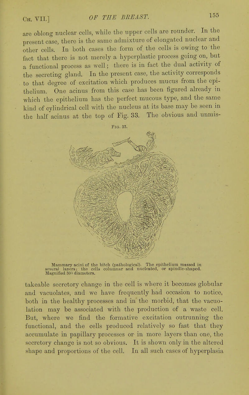 are oblong nuclear cells, while the upper cells are rounder. In the present case, there is the same admixture of elongated nuclear and other cells. In both cases the form of the cells is owing to the fact that there is not merely a hyperplastic process going on, but a functional process as well; there is in ffict the dual activity of the secreting gland. In the present case, the activity corresponds to that degree of excitation which produces mucus from the epi- thelium. One acinus from this case has been figured already in which the epithelium has the perfect mucous type, and the same kind of cylindrical cell with the nucleus at its base may be seen in the half acinus at the top of Fig. 33. The obvious and unmis- FlG. 33. Mammary acini of the bitch (pathological). The epithelium massed in several layers: the cells columnar and nucleated, or spindle-shaped. Magnified 300 diameters. takeable secretory change in the cell is where it becomes globular and vacuolates, and we have frequently had occasion to notice, both in the healthy processes and in the morbid, that the vacuo- lation may be associated with the production of a waste cell. But, where we find the formative excitation outrunning the functional, and the cells produced relatively so fast that they accumulate in papillary processes or- in more layers than one, the secretory change is not so obvious. It is shown only in the altered shape and proportions of the cell. In all such cases of hyperplasia