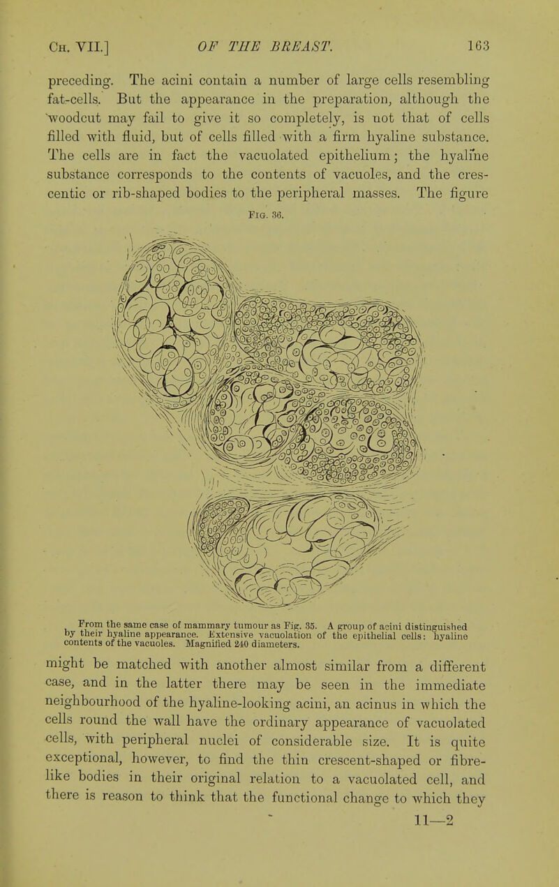 preceding. The acini contain a number of large cells resembling fat-cells. But the appearance in the preparation, although the woodcut may fail to give it so completely, is not that of cells filled with fluid, but of cells filled with a firm hyaline substance. The cells are in fact the vacuolated epithelium; the hyalfne substance corresponds to the contents of vacuoles, and the cres- centic or rib-shaped bodies to the peripheral masses. The figure Fia. 36. From the same case of mammary tumour as Pig. 35. A group of aoini distinguished by their hyaline appearance. Extensive vacuolation of the epithelial cells: hyaline contents of the vacuoles. MagniJied 240 diameters. might be matched with another almost similar from a different case, and in the latter there may be seen in the immediate neighbourhood of the hyaline-looking acini, an acinus in which the cells round the wall have the ordinary appearance of vacuolated cells, with peripheral nuclei of considerable size. It is quite exceptional, however, to find the thin crescent-shaped or fibre- like bodies in their original relation to a vacuolated cell, and there is reason to think that the functional change to which they 11—2