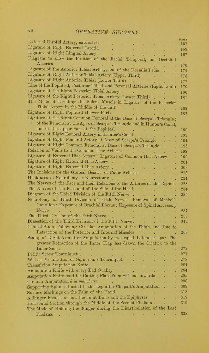OPE It A Tl VE 8 UliU EliY. External Carotid Artery, natural sizo .... . 157 159 167 170 174 176 177 Ligature of Eight External Carotid Ligature of Right Lingual Artery Diagram to show the Position of the Facial, Temporal, and Occipital Arteries ....... Ligature of the Anterior Tibial Artery, and of the Dorsalis Pedis Ligature of Eight Anterior Tibial Artery (Upper Third) . Ligature of Eight Anterior Tibial (Lower Third) Line of the Popliteal, Posterior Tibial, and Peroneal Arteries (Eight Limb) 179 Ligature of the Eight Posterior Tibial Artery 180 Ligature of the Eight Posterior Tibial Artery (Lower Third) . . .181 The Mode of Dividing the Soleus Muscle in Ligature of the Posterior Tibial Artery in the Middle of the Calf 182 Ligature of Eight Popliteal (Lower Part) 187 Ligature of the Eight Common Femoral at the Base of Scarpa's Triangle; of the Femoral at the Apex of Scarpa's Triangle and in Hunter's Canal, and of the Upper Part of the Popliteal 190 Ligature of Eight Femoral Artery in Hunter's Canal . . . .193 Ligature of Eight Femoral Artery at Apex of Scarpa's Triangle . • . 194 Ligature of Eight Common Femoral at Base of Scarpa's Triangle . .195 Eelation of Veins to the Common Iliac Arteries 198 Ligature of External Iliac Artery : Ligature of Common Diac Artery . 199 Ligature of Eight External Iliac Artery 201 Ligature of Eight External Diac Artery 203 The Incisions for the Gluteal, Sciatic, or Pudic Arteries . . . .215 Hook used in Neurotomy or Neurectomy 224 The Nerves of the Face and their Eelations to the Arteries of the Eegion. 228 The Nerves of the Face and of the Side of the Head 234 Diagram of the Third Division of the Fifth Nerve 235 Neurotomy of Third Division of Fifth Nerve: Eemoval of Meckel's Ganglion : Exposure of Brachial Plexus : Exposure of Spinal Accessory Nerve 237 The Third Division of the Fifth Nerve 239 Dissection of the Third Division of the Fifth Nerve 242 Conical Stump following Circular Amputation of the Thigh, and Due to Eetraction of the Posterior and Internal Muscles .... 269 Stump of Eight Arm after Amputation by two equal Lateral Flaps : The greater Eetraction of the Inner Flap has drawn the Cicatrix to the Inner Side 272 Petit's Screw Tourniquet 277 Weiss's Modification of Signoroni's Tourniquet. . . . . . 27S Transfixion Amputation Knife 2S4 Amputation Knife with every Bad Quality . . . . . .284 Amputation Knife used for Cutting Flaps from without inwards Circular Amputation a la manchette ........ 290 Supporting Splint adjusted to the Leg after Chopart's Amputation . . 309 Surface Markings on the Palm of the Hand A Finger Flexed to show the Joint Lines and the Epiphyses . . .319 Horizontal Section through the Middle of the Second Phalanx . . .319 The Mode of Holding the Finger during the Disarticulation of the Last Phalanx 323