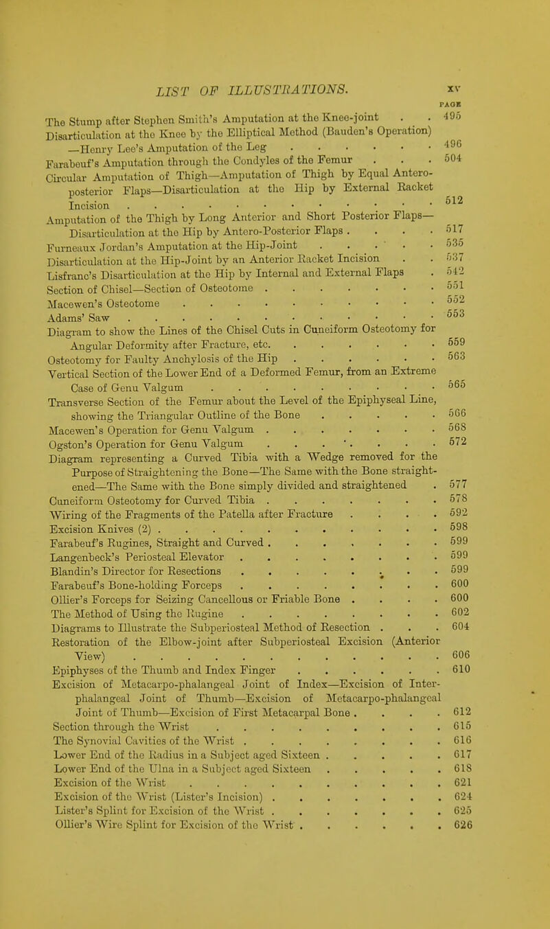 The Stump after Stephen Smith's Amputation at the Knee-joint Disarticulation at tho Knee by the Elliptical Method (Bauden's Operation) —Henry Lee's Amputation of the Leg Farabeuf's Amputation through the Condyles of the Femur Circular Amputation of Thigh—Amputation of Thigh by Equal Antero- posterior Flaps—Disarticulation at the Hip by External Racket Incision Amputation of the Thigh by Long Anterior and Short Posterior Flaps— Disarticulation at tho Hip by Antoro-Postcrior Flaps .... Furneaux Jordan's Amputation at the Hip-Joint . . . Disarticulation at the Hip-Joint by an Anterior Racket Incision Lisfranc's Disarticulation at the Hip by Internal and External Flaps Section of Chisel—Section of Osteotome Macewen's Osteotome Adams' Saw Diagram to show the Lines of the Chisel Cuts in Cuneiform Osteotomy for Angular Deformity after Fracture, etc Osteotomy for Faulty Anchylosis of the Hip Vertical Section of the Lower End of a Def ormed Femur, from an Extreme Case of Genu Valgum Transverse Section of the Femur about the Level of the Epiphyseal Line, showing the Triangular Outline of the Bone Macewen's Operation for Genu Valgum Ogston's Operation for Genu Valgum . . . Diagram representing a Curved Tibia with a Wedge removed for the Purpose of Straightening the Bone—The Same with the Bone straight- ened—The Same with the Bone simply divided and straightened Cuneiform Osteotomy for Curved Tibia . Wiring of the Fragments of the Patella after Fracture Excision Knives (2) Farabeuf's Rugines, Straight and Curved . Langenbeck's Periosteal Elevator Blandin's Director for Resections Farabeuf's Bone-holding Forceps Ollier's Forceps for Seizing Cancellous or Friable Bone The Method of Using the Rugine .... Diagrams to Illustrate the Subperiosteal Method of Resection Restoration of the Elbow-joint after Subperiosteal Excision View) Epiphyses of the Thumb and Index Finger Excision of Metacarpophalangeal Joint of Index—Excision of Inter- phalangcal Joint of Thumb—Excision of Metacarpophalangeal Joint of Thumb—Excision of First Metacarpal Bone Section through the Wrist ..... The Synovial Cavities of the Wrist .... Lower End of tho Radius in a Subject aged Sixteen . Lower End of the Ulna in a Subject aged Sixteen Excision of the Wrist ...... Excision of the' Wrist (Lister's Incision) . Lister's Splint for Excision of the Wrist . Ollier's Wire Splint for Excision of tho Wrist . PAOB 495 496 504 512 517 535 537 542 551 552 553 559 563 565 566 563 572 577 578 592 598 599 599 599 600 600 602 604 (Anterior 606 610 612 615 616 617 618 621 624 625 626